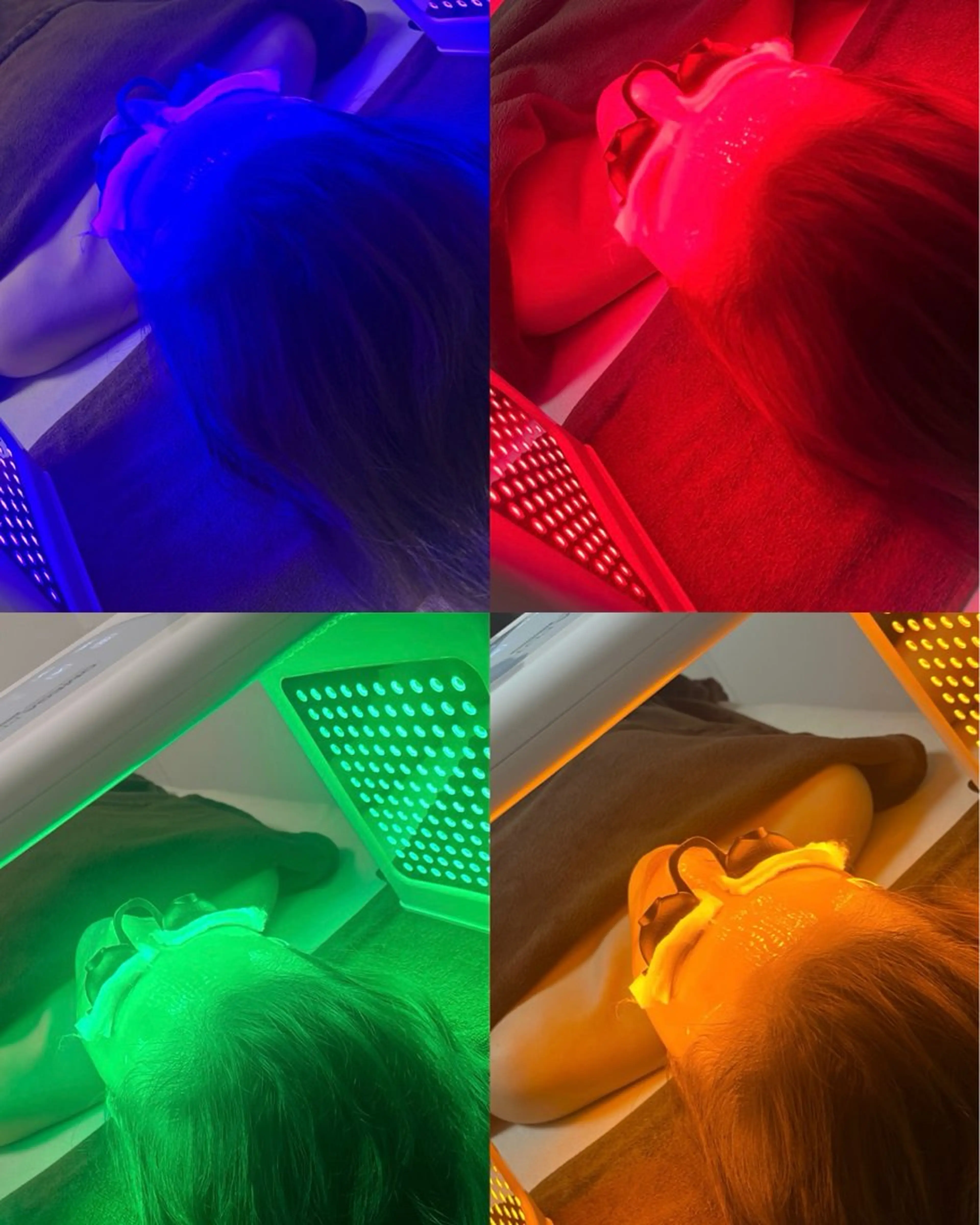 ニキビ、ニキビ跡、赤みに◎【最新LED美容】韓国肌管理の写真