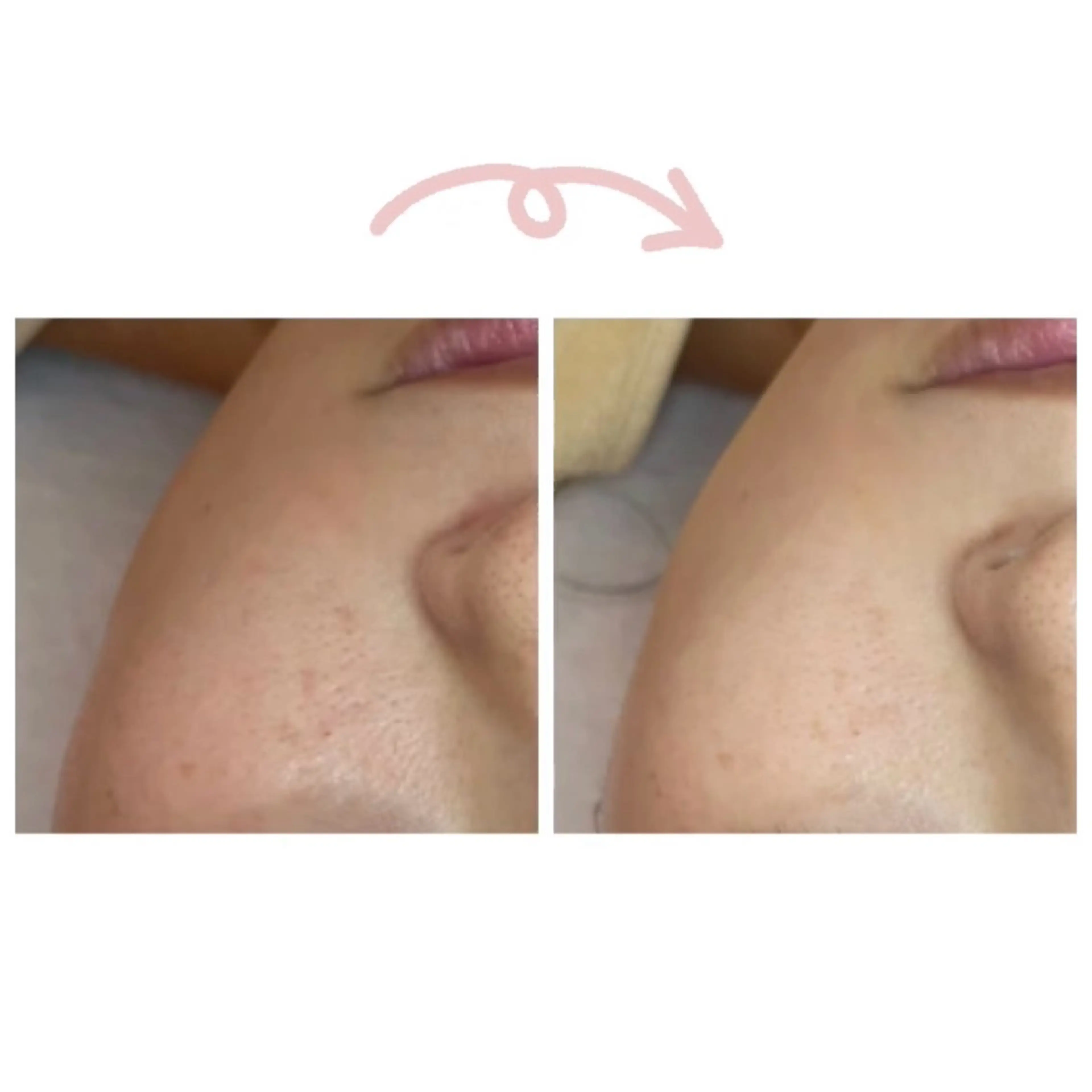 エステ ニキビ/敏感肌/乾燥 Lilyauraのエステ・リラクイメージ