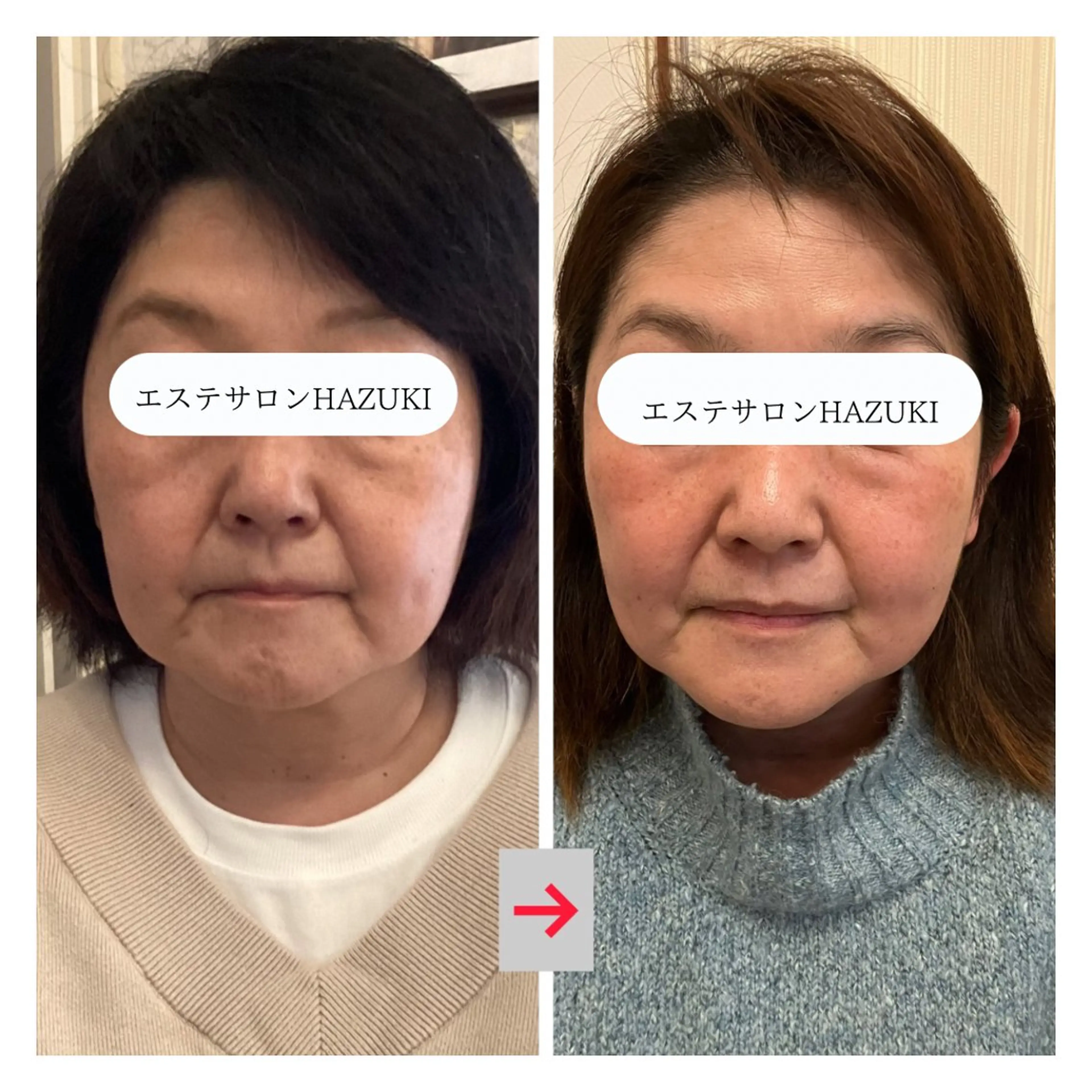 その他 たるみ改善小顔エステ 堀葉月のその他イメージ