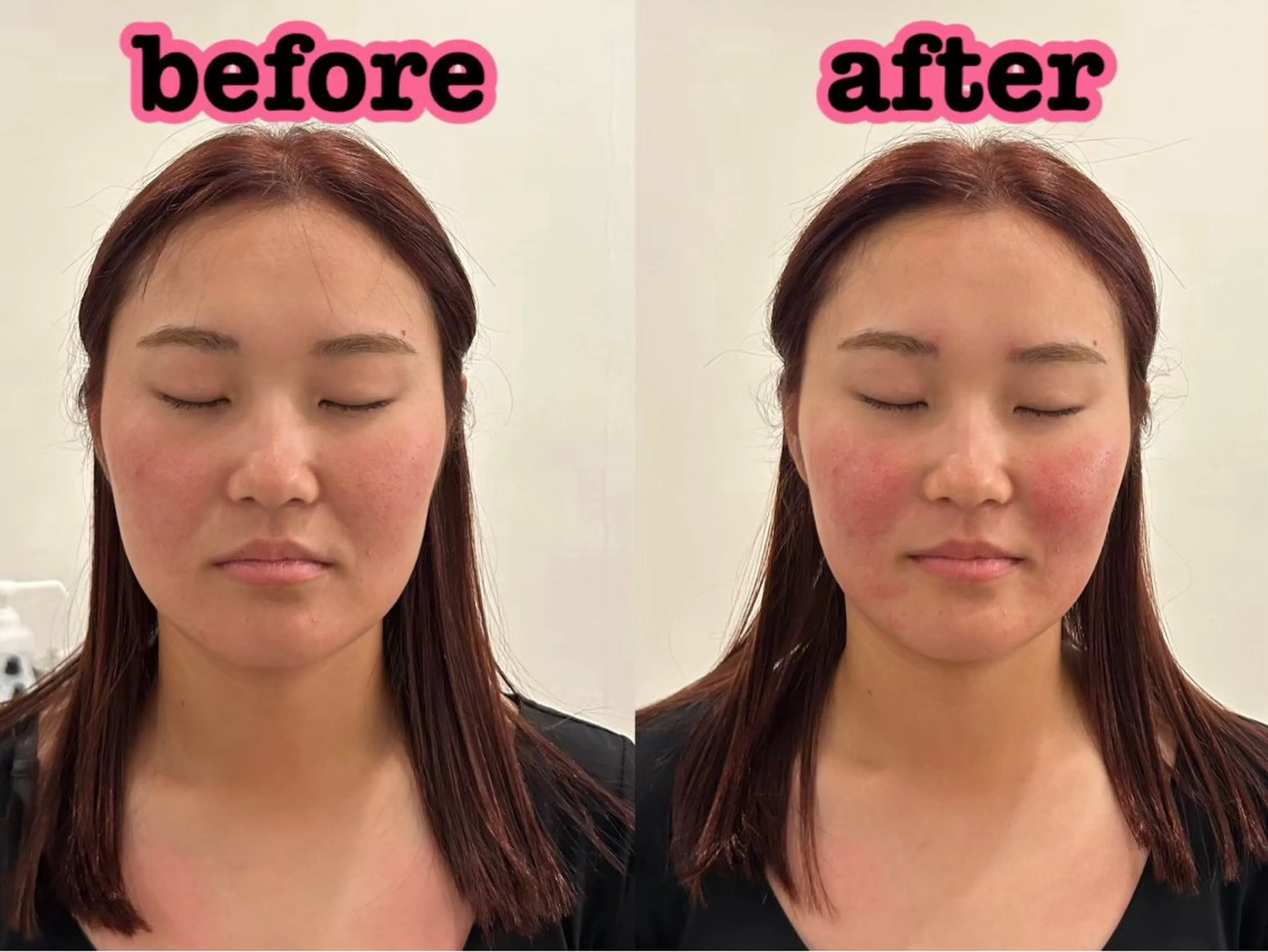 エステ リラク 美容鍼灸Solana所属・肌質改善×美容鍼 ゆいのエステ・リラクイメージ