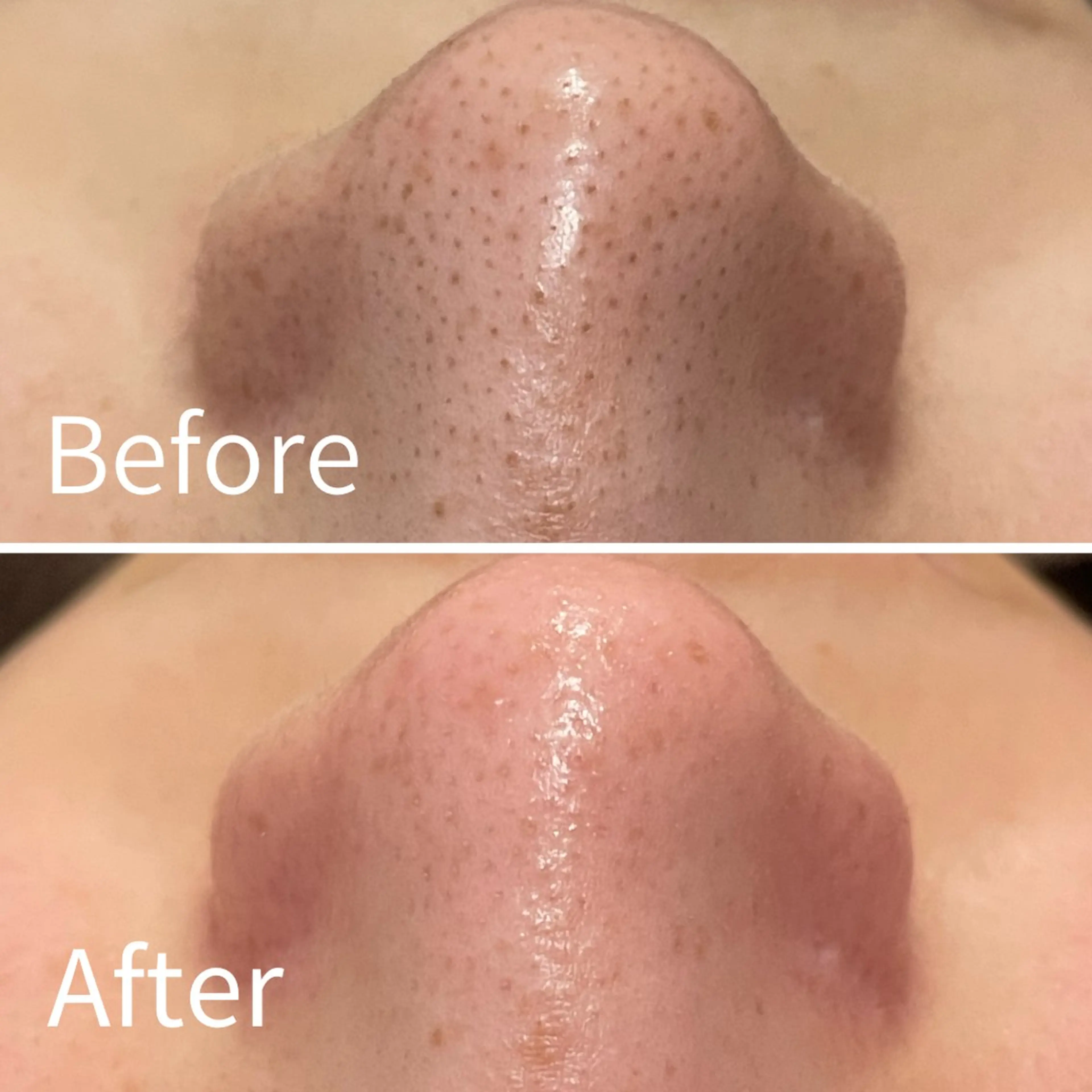 【平日16：00まで初回】ハイドロ毛穴洗浄×イオン導入　¥11,000→¥ 5,980【口コミ割】の写真