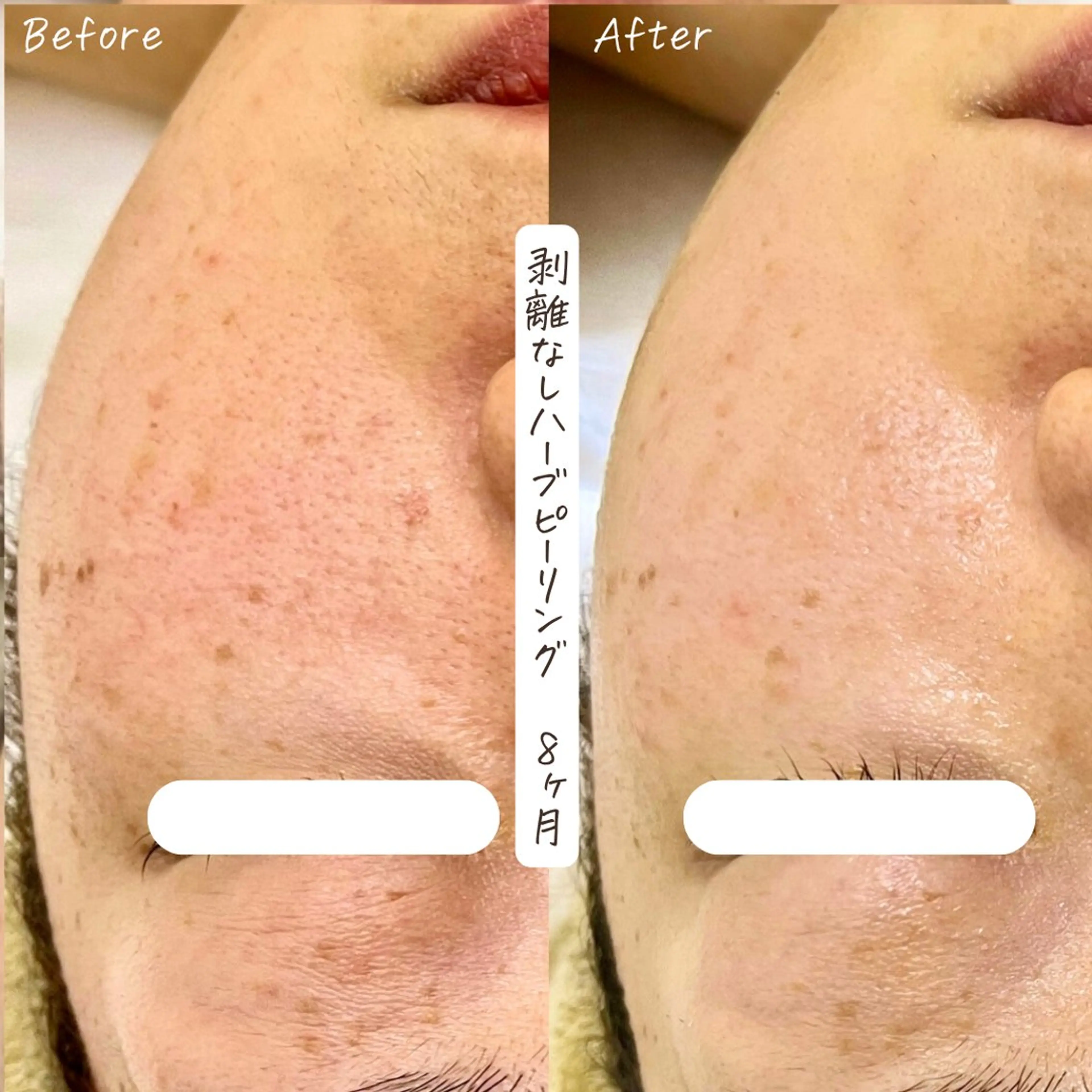 肌質改善サロン renew/ｳｴｷのエステ・リラクイメージ