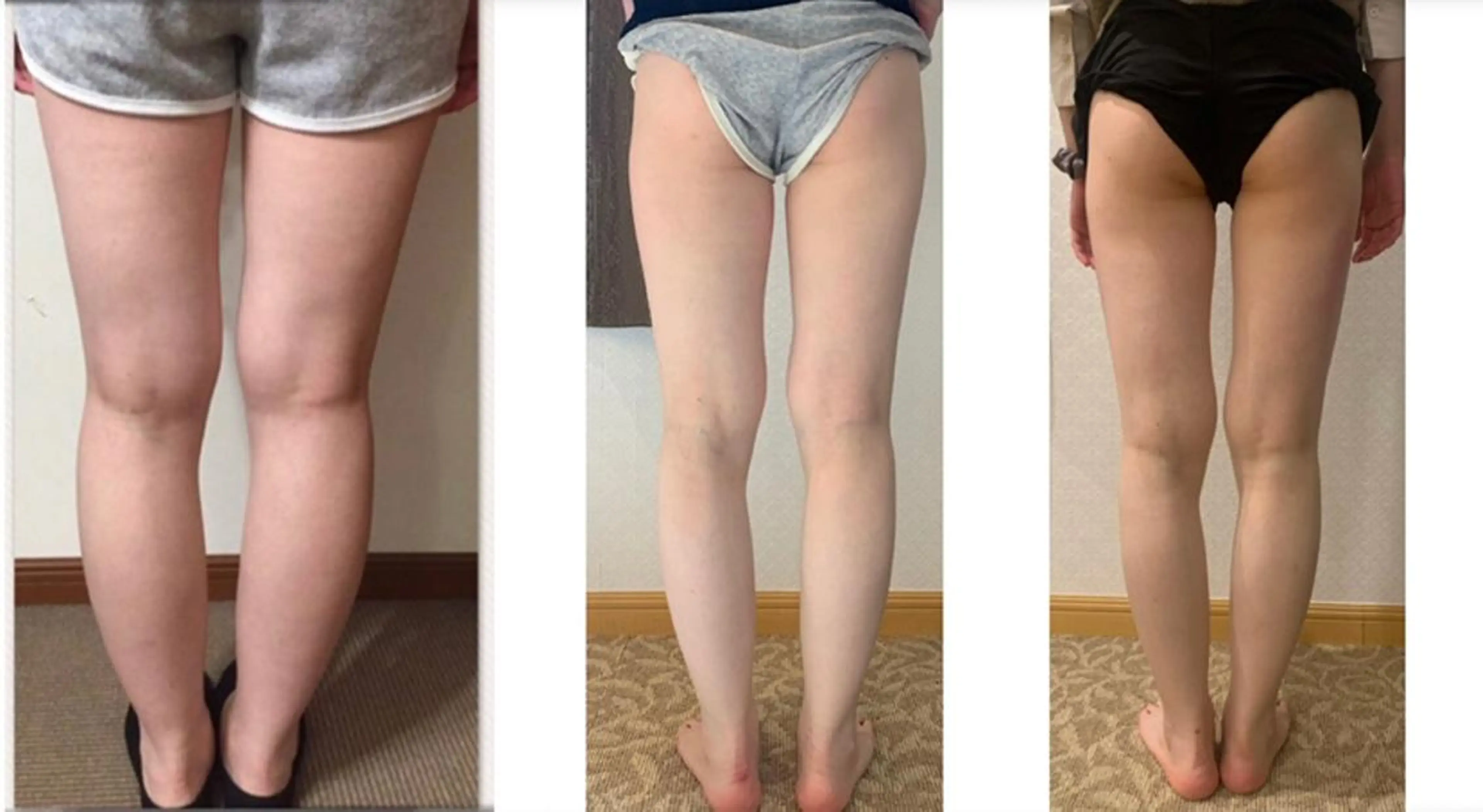 美脚スッキリコースの写真