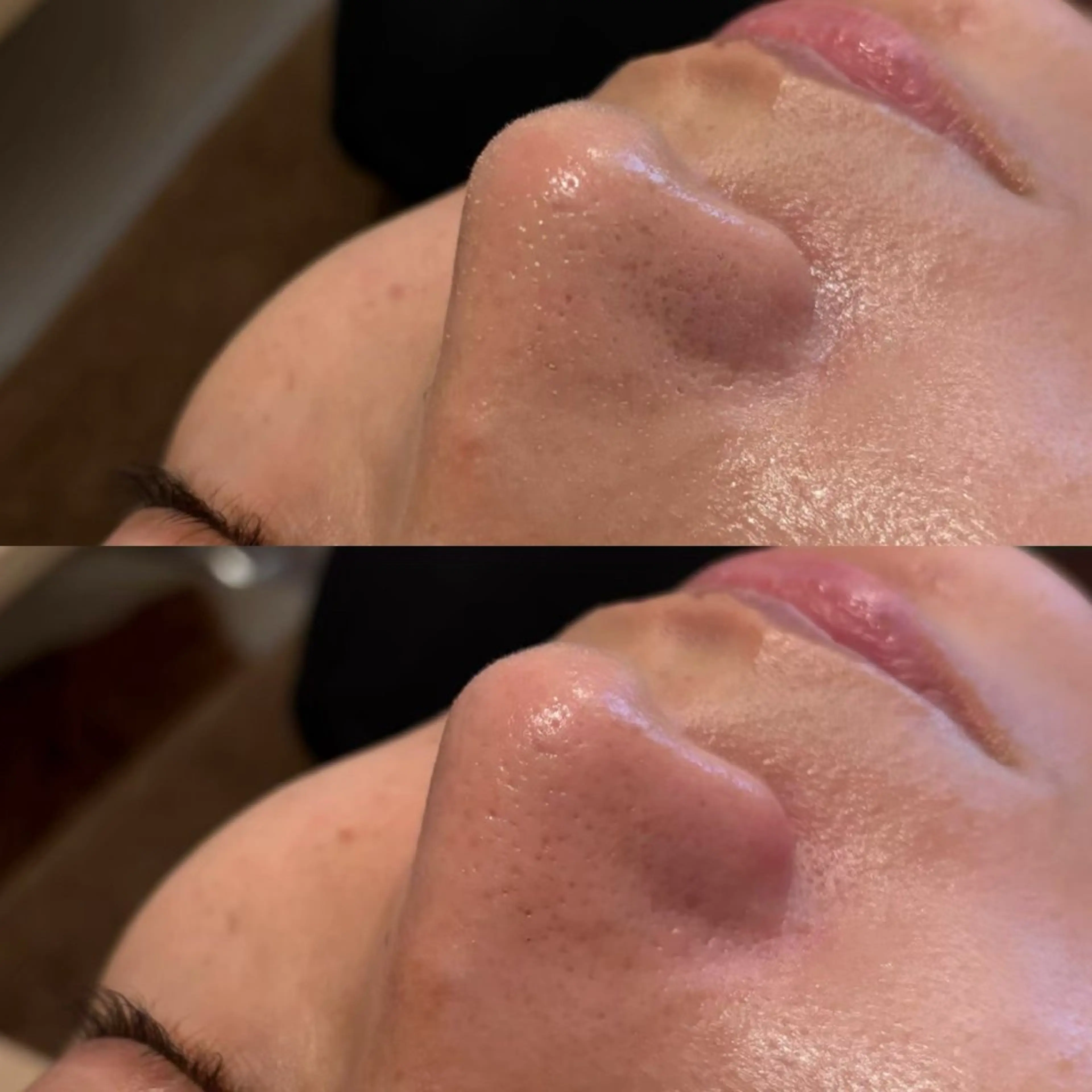 無料体験✨毛穴ゴッソリ洗浄🫧（詳細確認必須）の写真