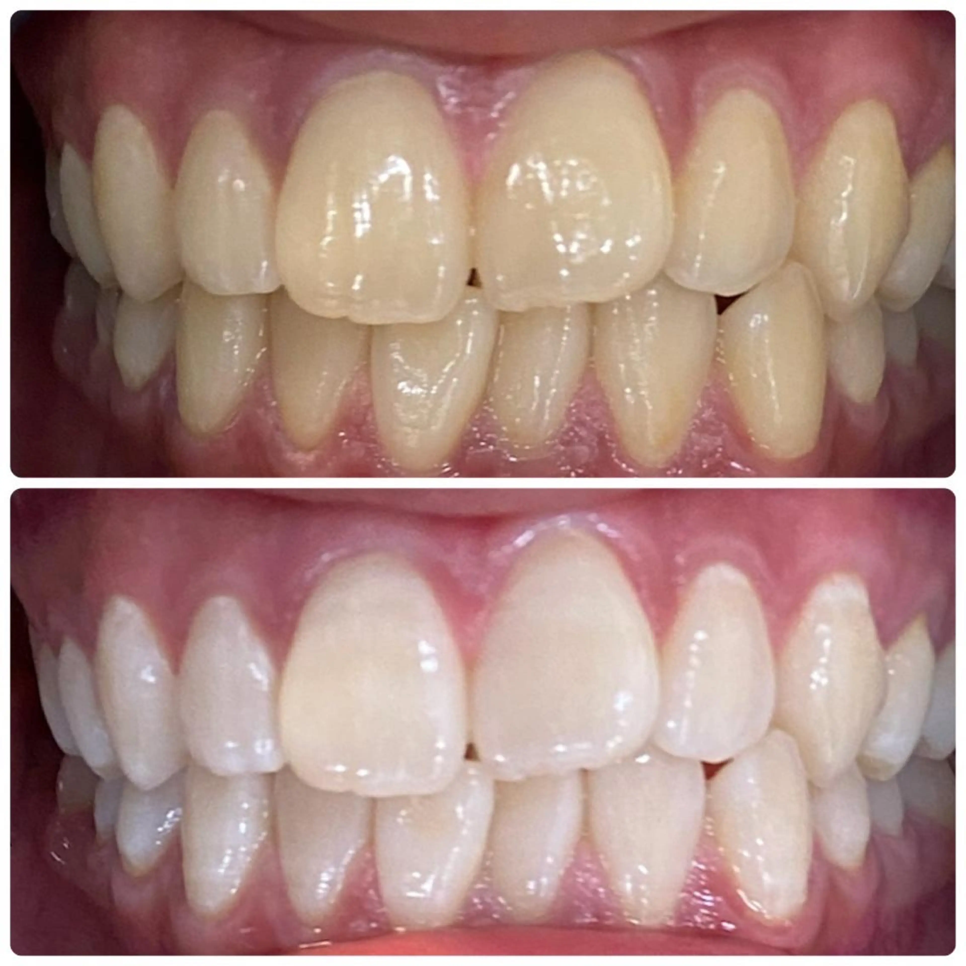 【期間限定】頑固な着色に！たっぷり40分照射🦷セルフホワイトニングの写真