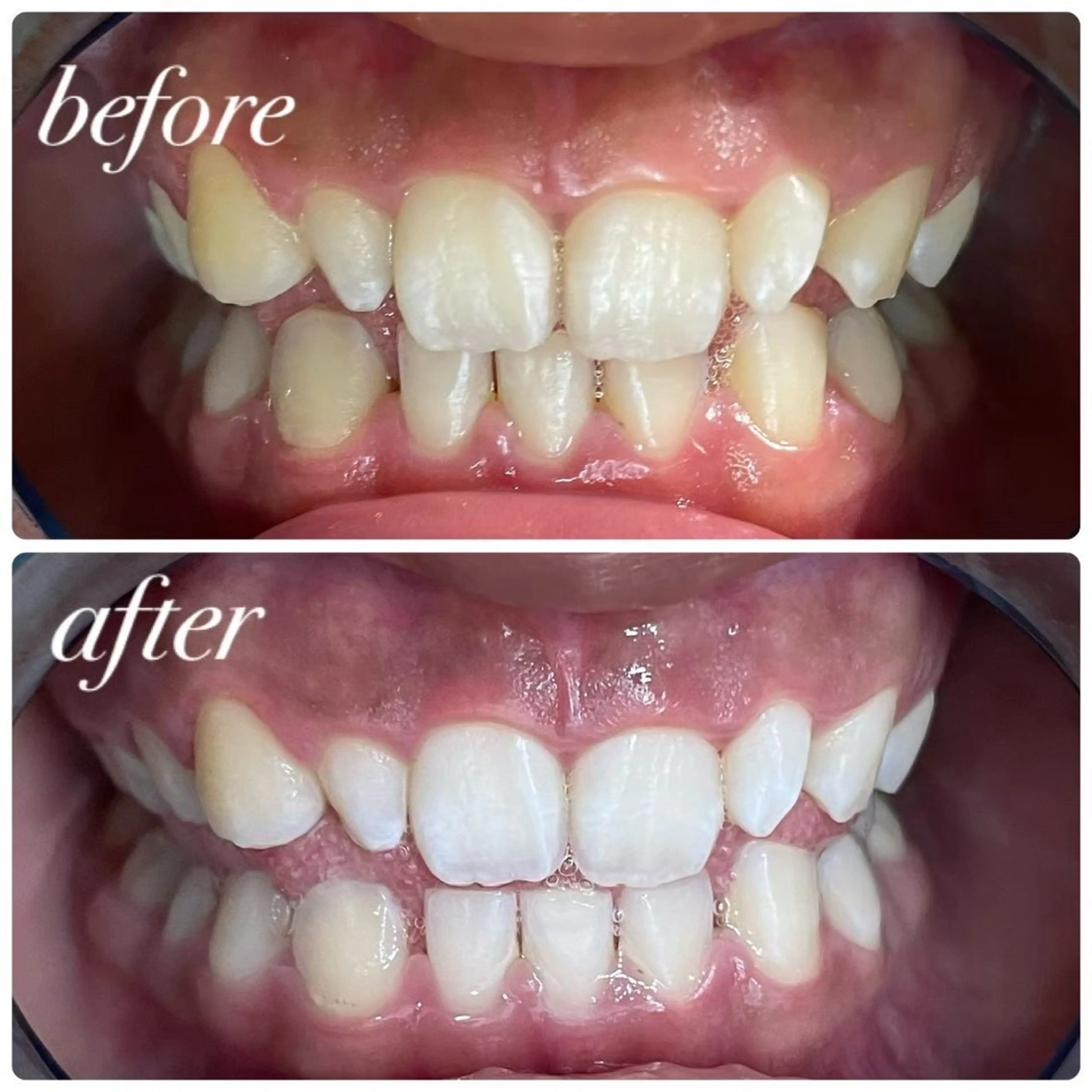 🏫セルフホワイトニング🏫学割‼️初回体験10分x3回 ～安心のカウンセリング付き​〜​の写真