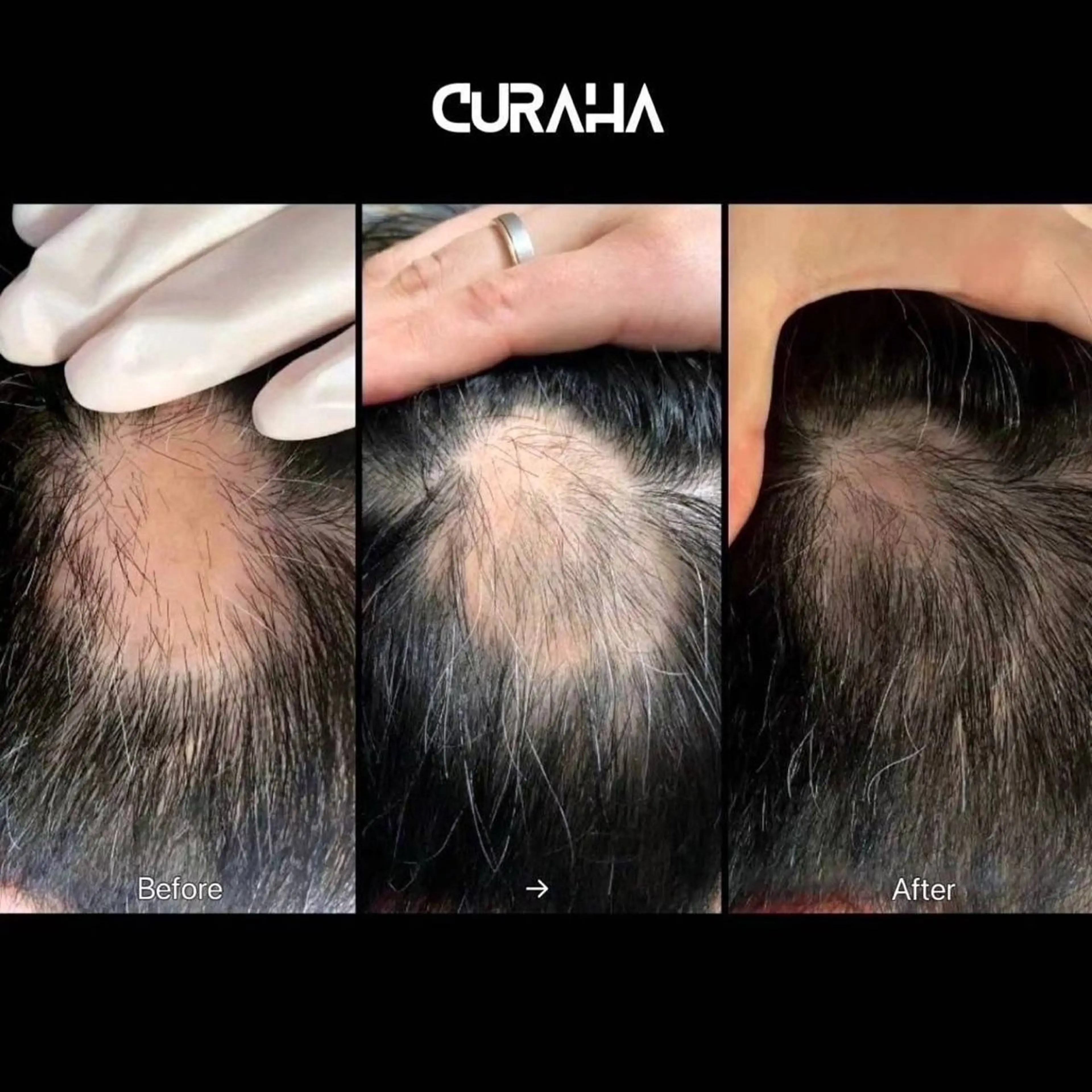 韓国最新薄毛対策(1回¥15,000を月2回来店メニュー月2回で¥22,000)の写真