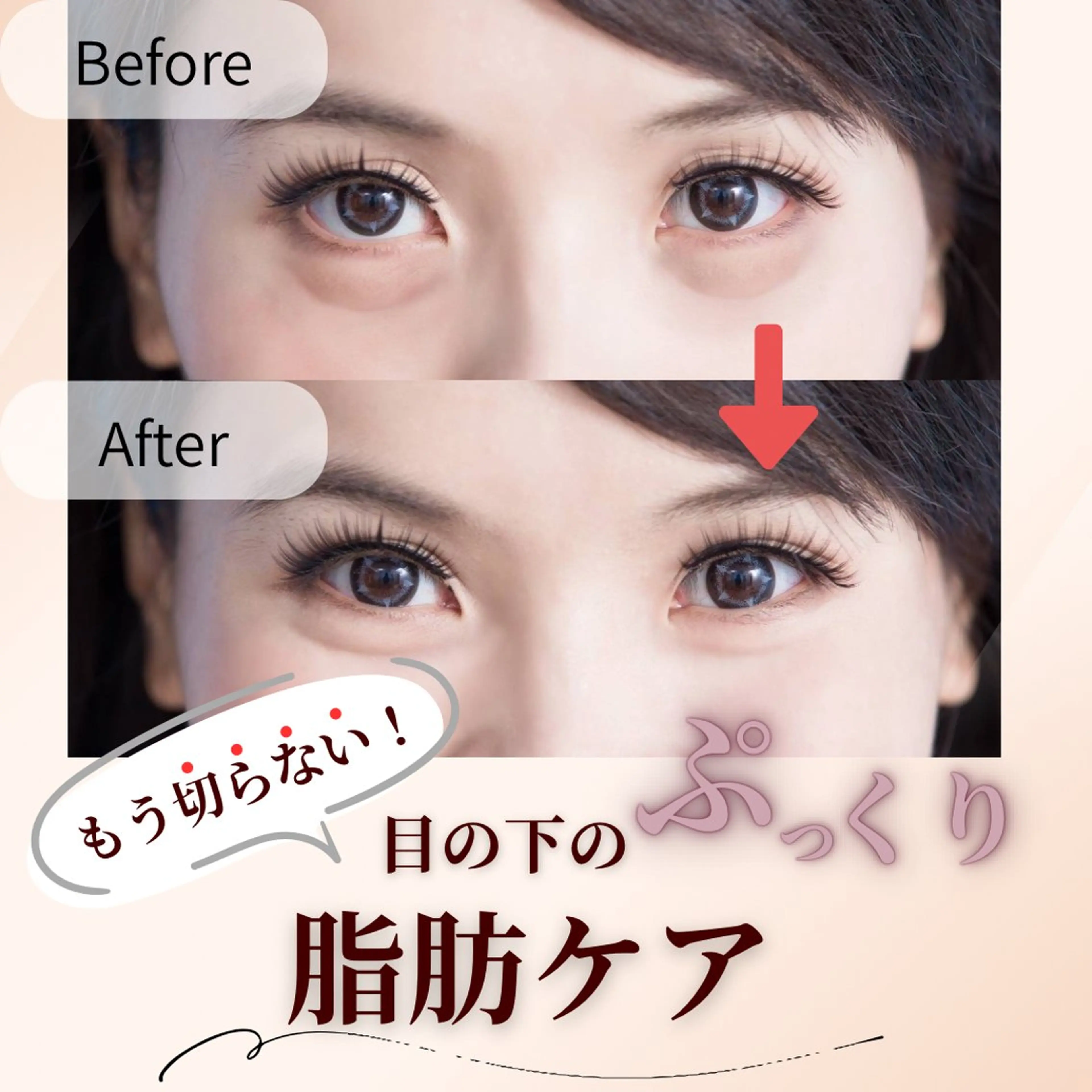 もう切らない！目の下のぷっくり脂肪ケア《体験2回》の写真
