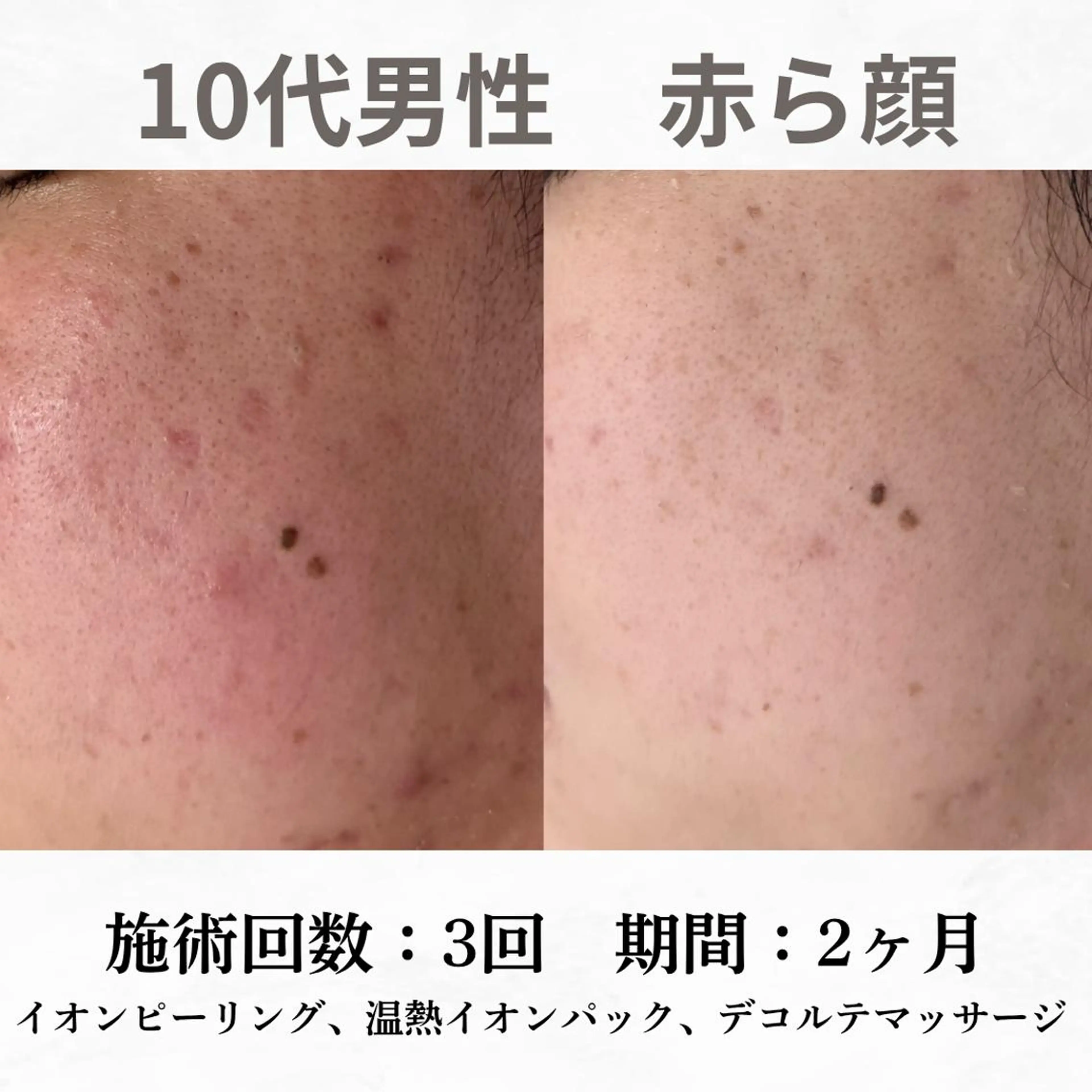 重度ニキビ専門🌷 ダウンタイムなしのエステ・リラクイメージ