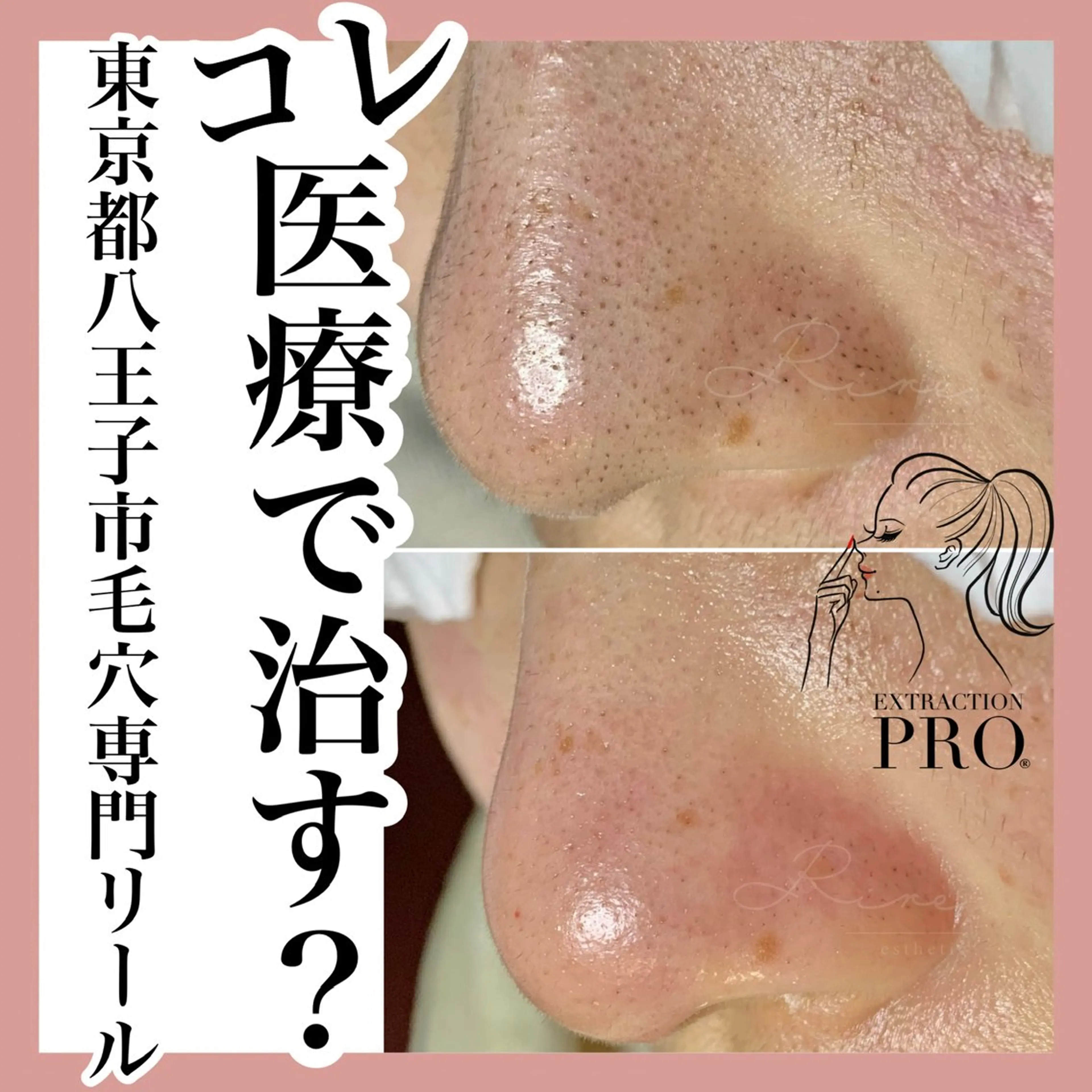 毛穴特化エステ -リールのエステ・リラクイメージ