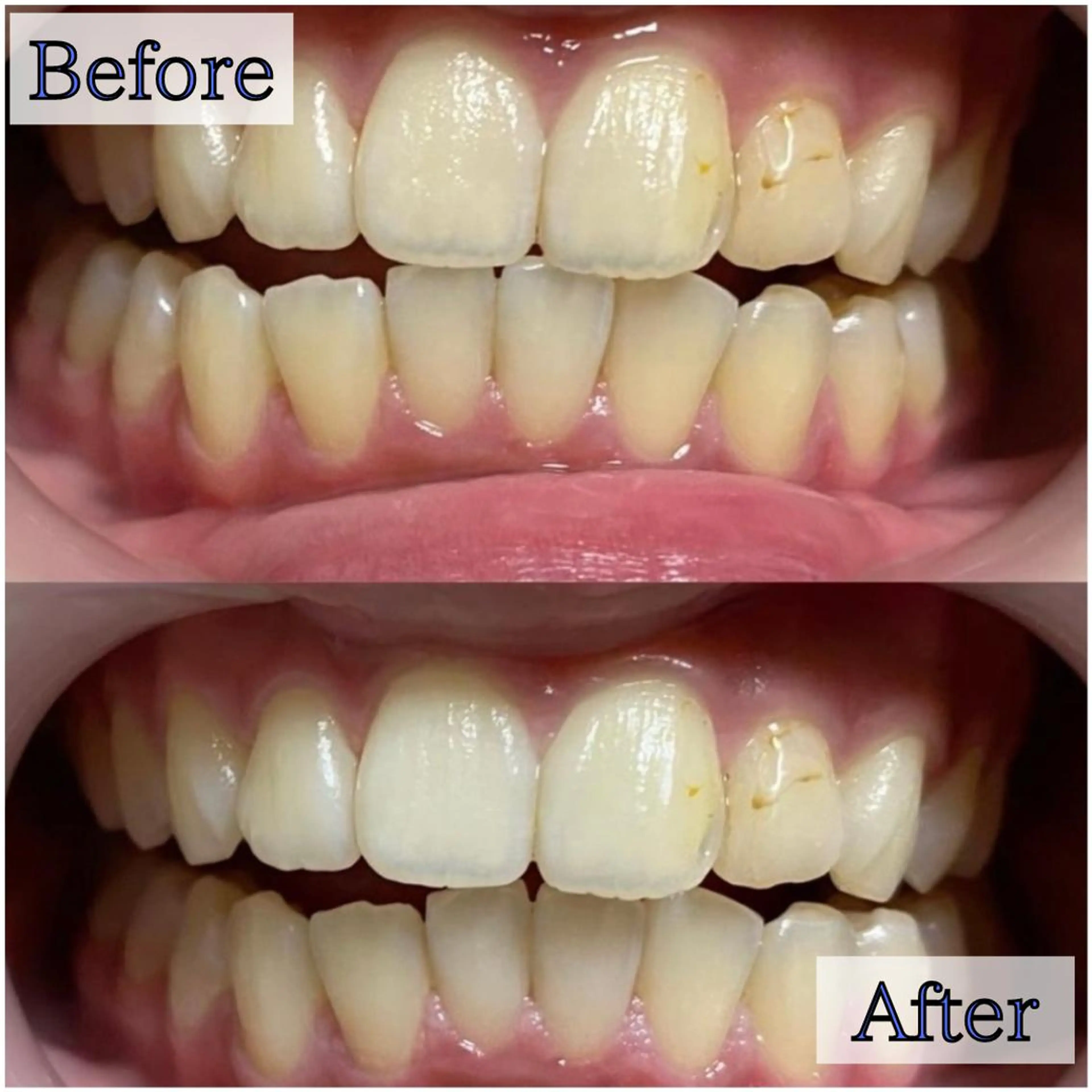 その他 LBSホワイトニング 新宿店💎公式のその他イメージ