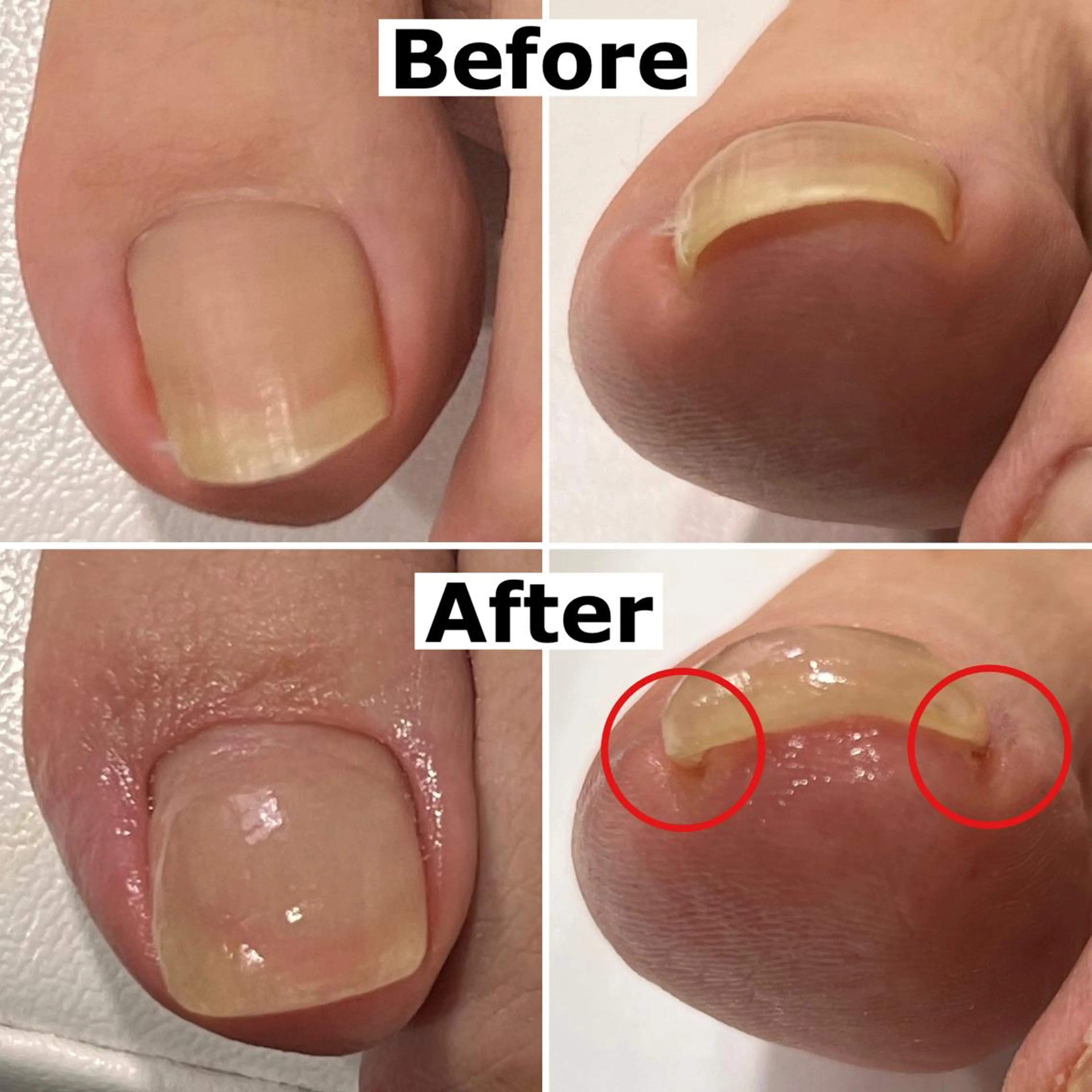 ネイル 巻爪無料モデル募集 ✨🦶MEGUMIのネイルデザイン