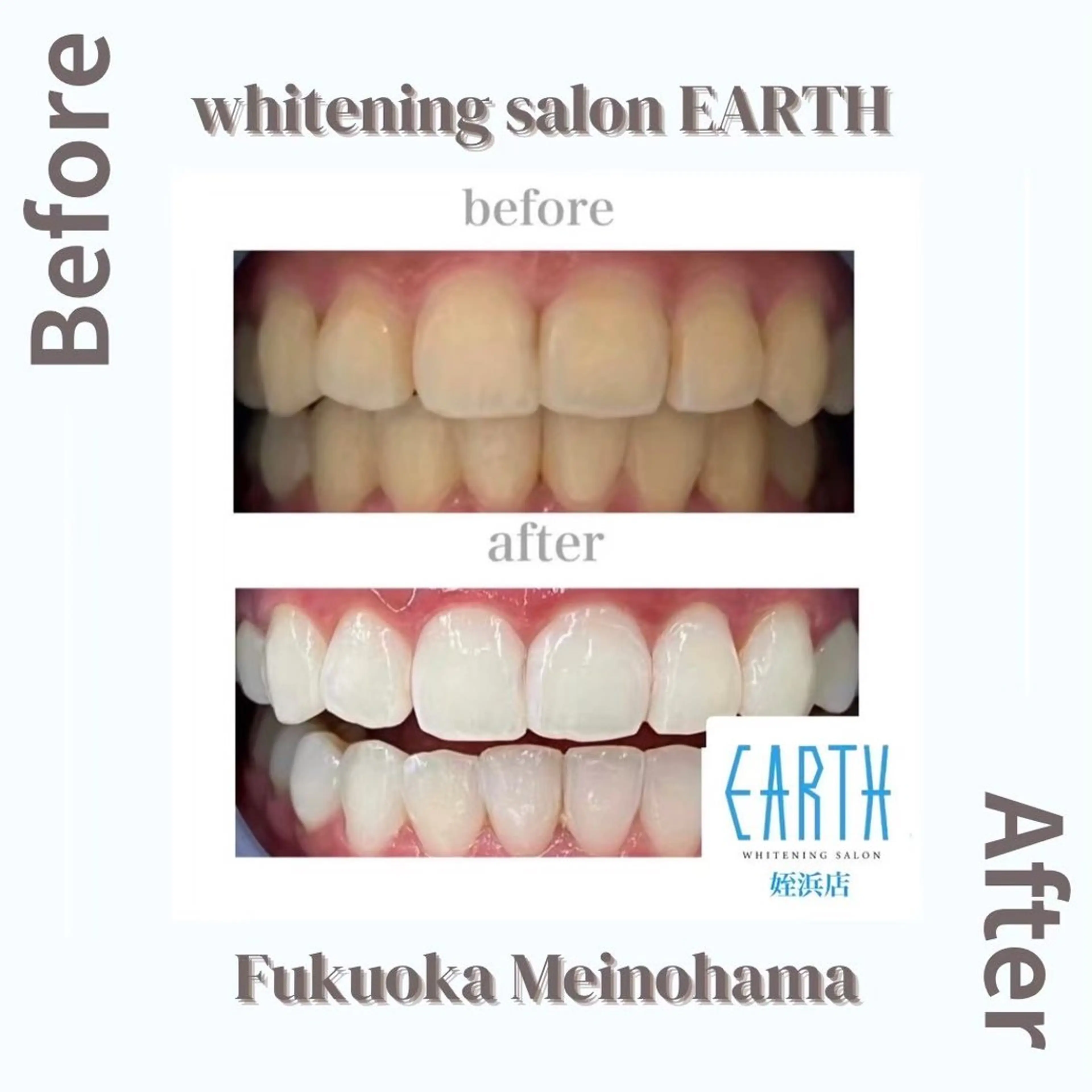 【お試しプラン】美白ホワイトニング10回コース 20分×10回 基本的には5日分の写真