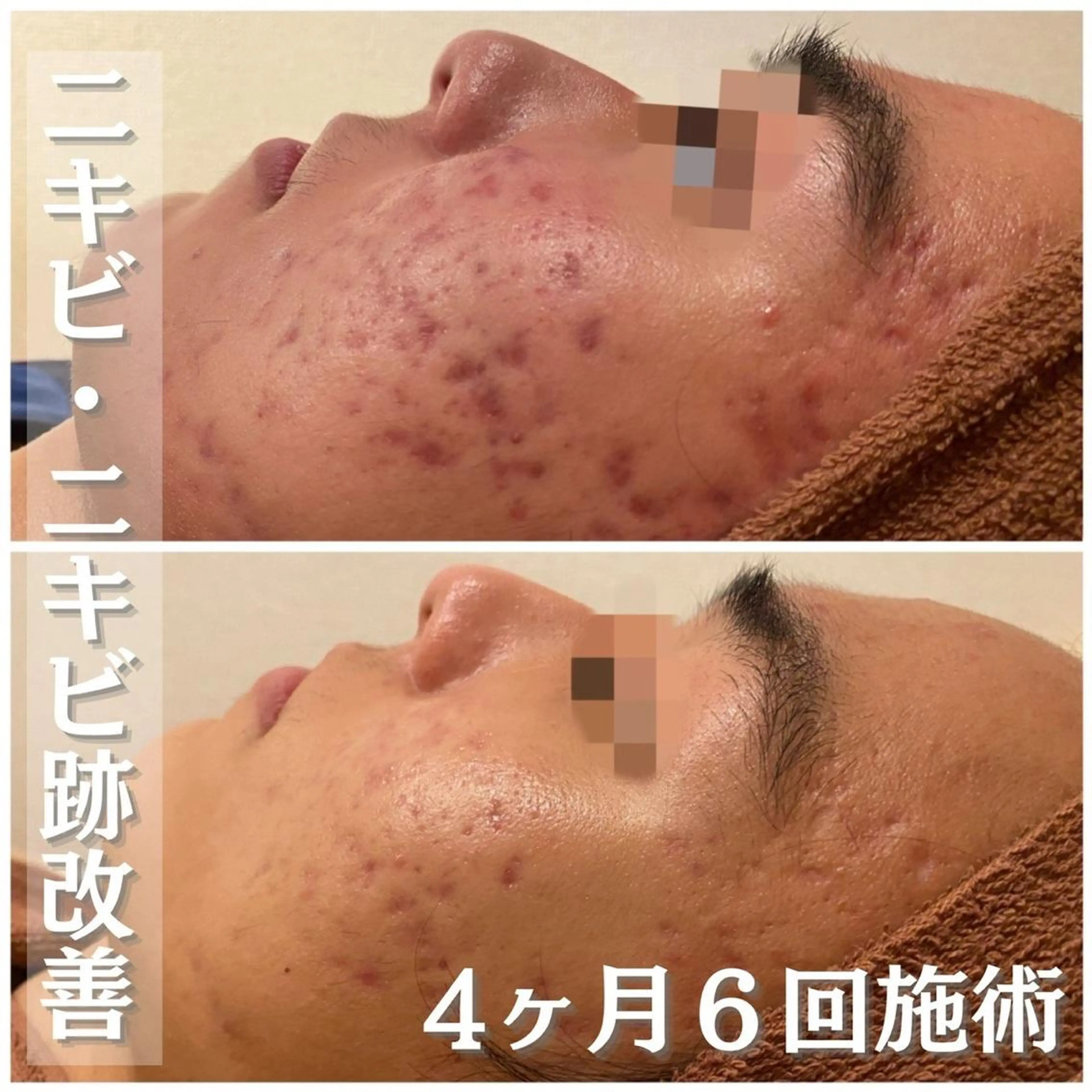 セミロング カラー パーマ ヘアアレンジ メンズ キッズ ネイル マツエク・マツパ アイブロウ 3か月で肌革命👼 ニキビ専門店💫のエステ・リラクイメージ