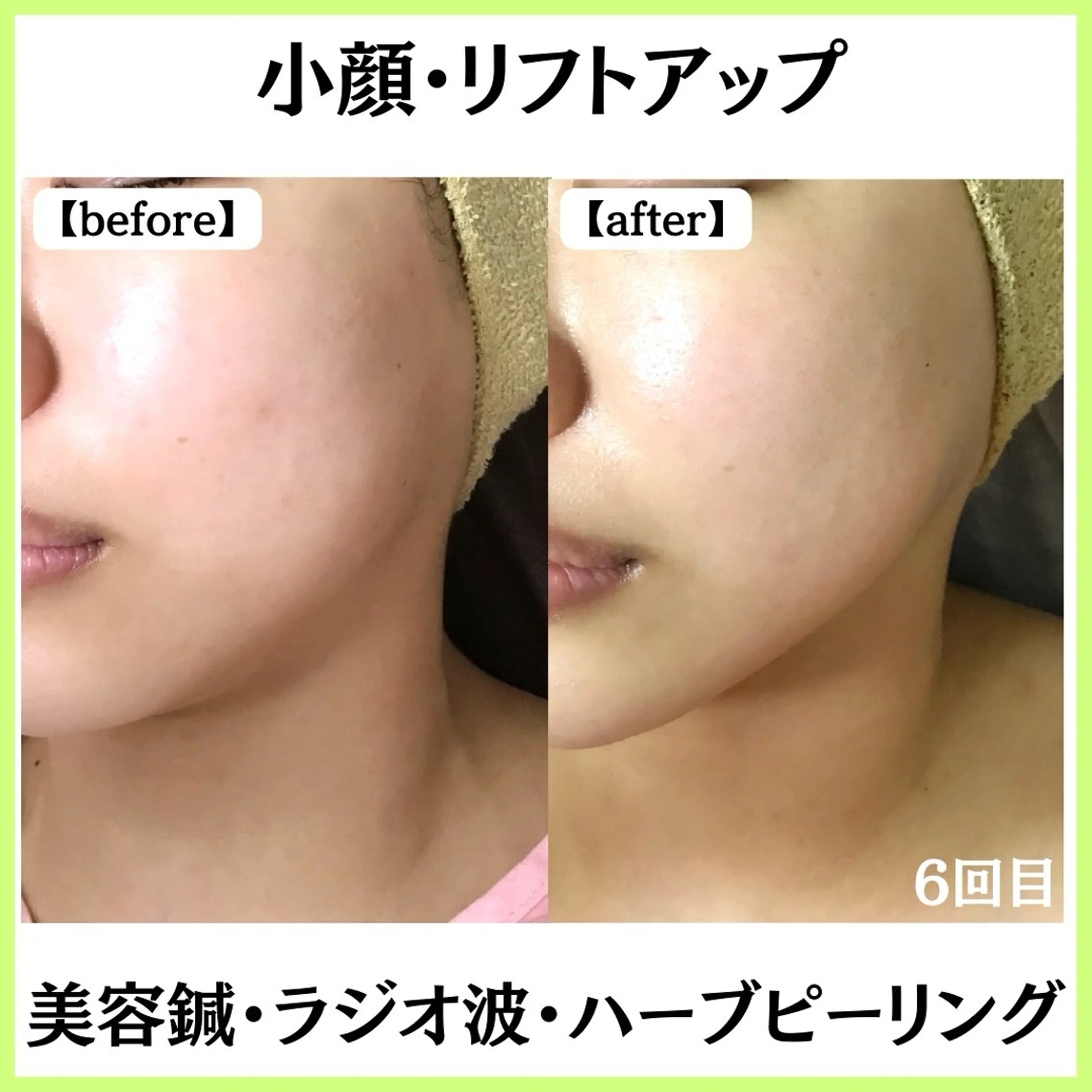 小顔ハーブピーリング 美容鍼/毛穴洗浄のエステ・リラクイメージ