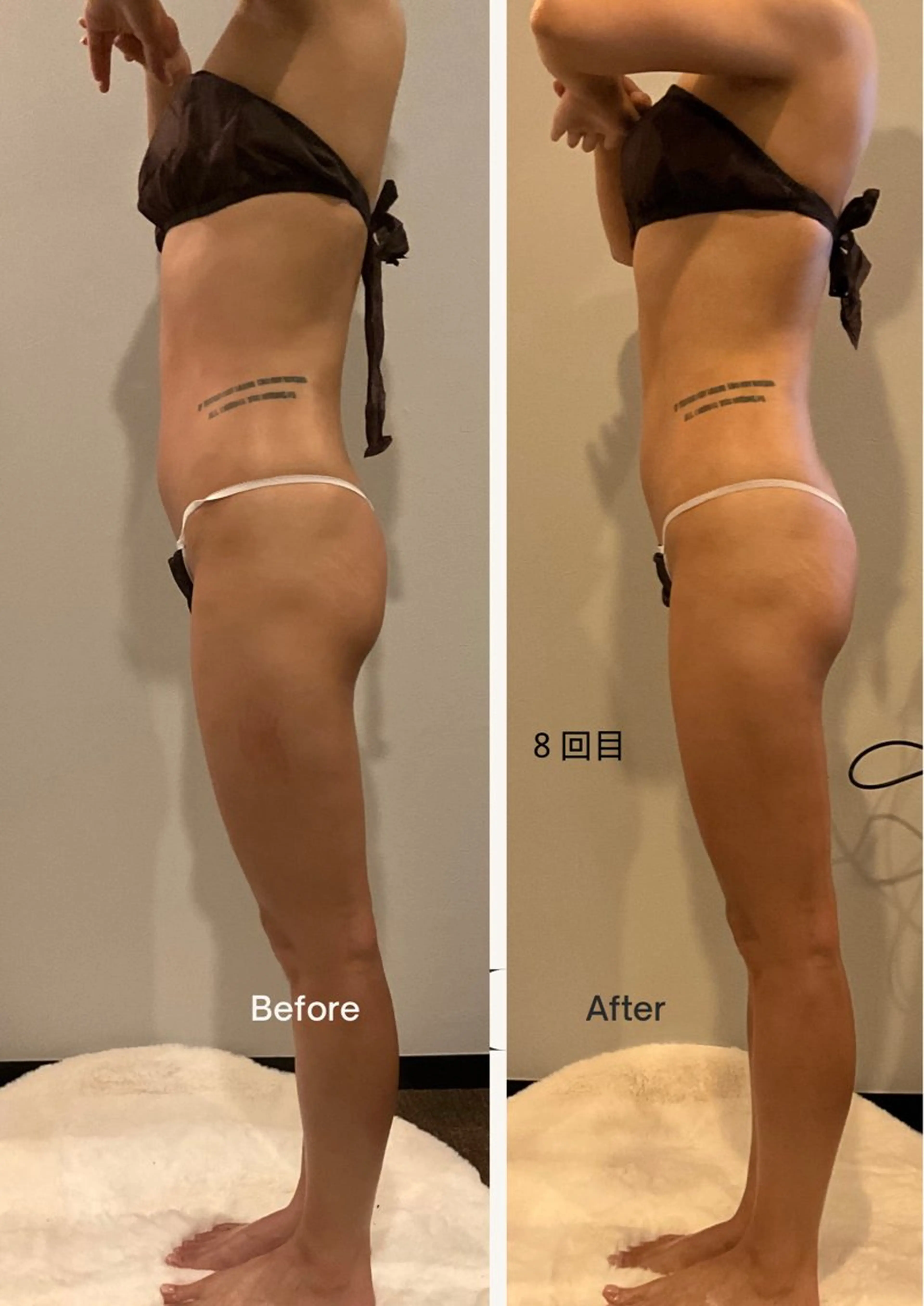 [美脚*美尻集中コース]ハイパーナイフEx+リンパマッサージ60分の写真