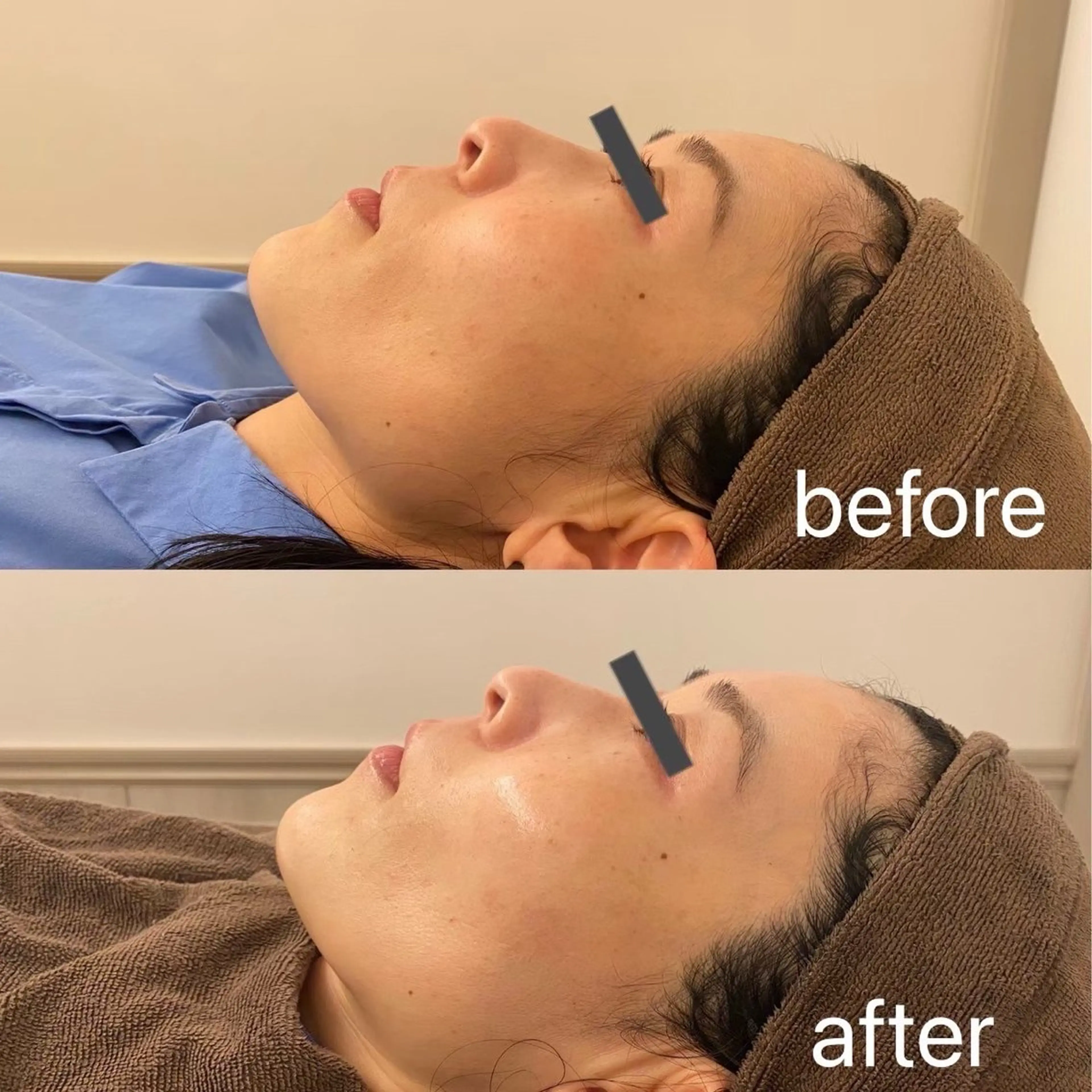 お顔脱毛の写真