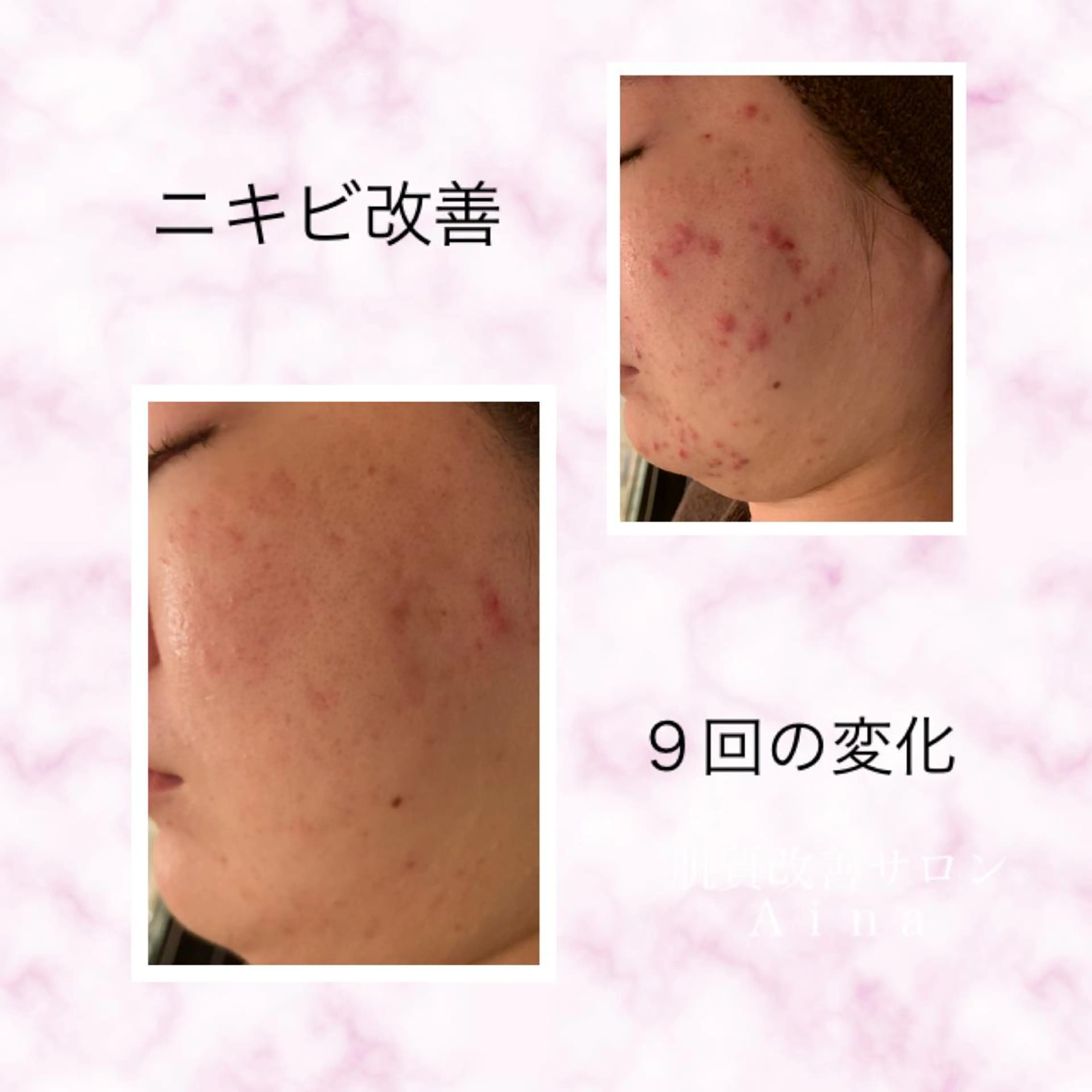 ミディアム カラー パーマ ヘアアレンジ メンズ キッズ ネイル マツエク・マツパ ニキビ跡専門サロン Ａｉｎａのエステ・リラクイメージ