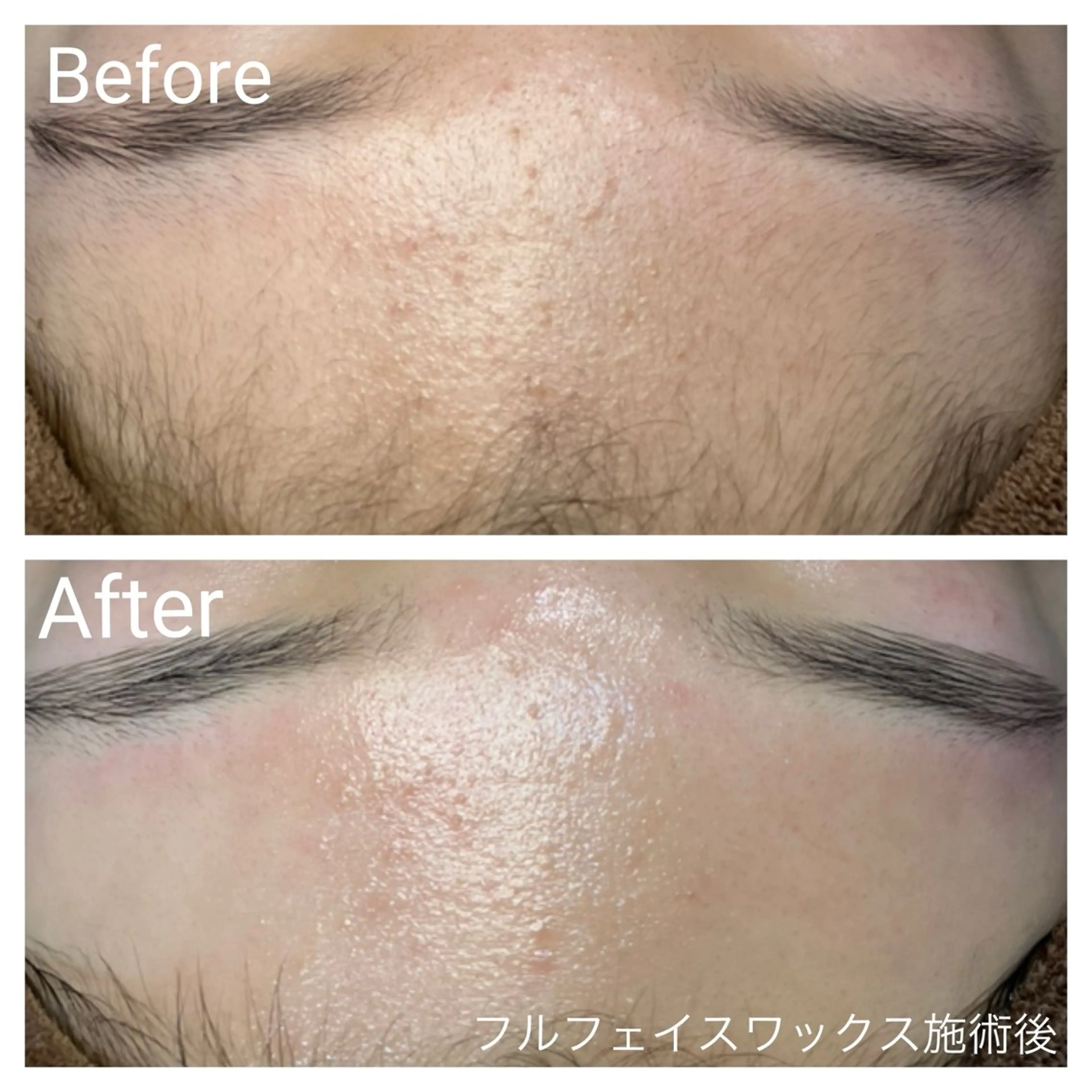 ⭐️選べる3パーツ⭐️艶肌フェイスワックス60分(鼻・眉間・顎・鼻下)の中から選択可能＋お仕上げトリートメント付きの写真