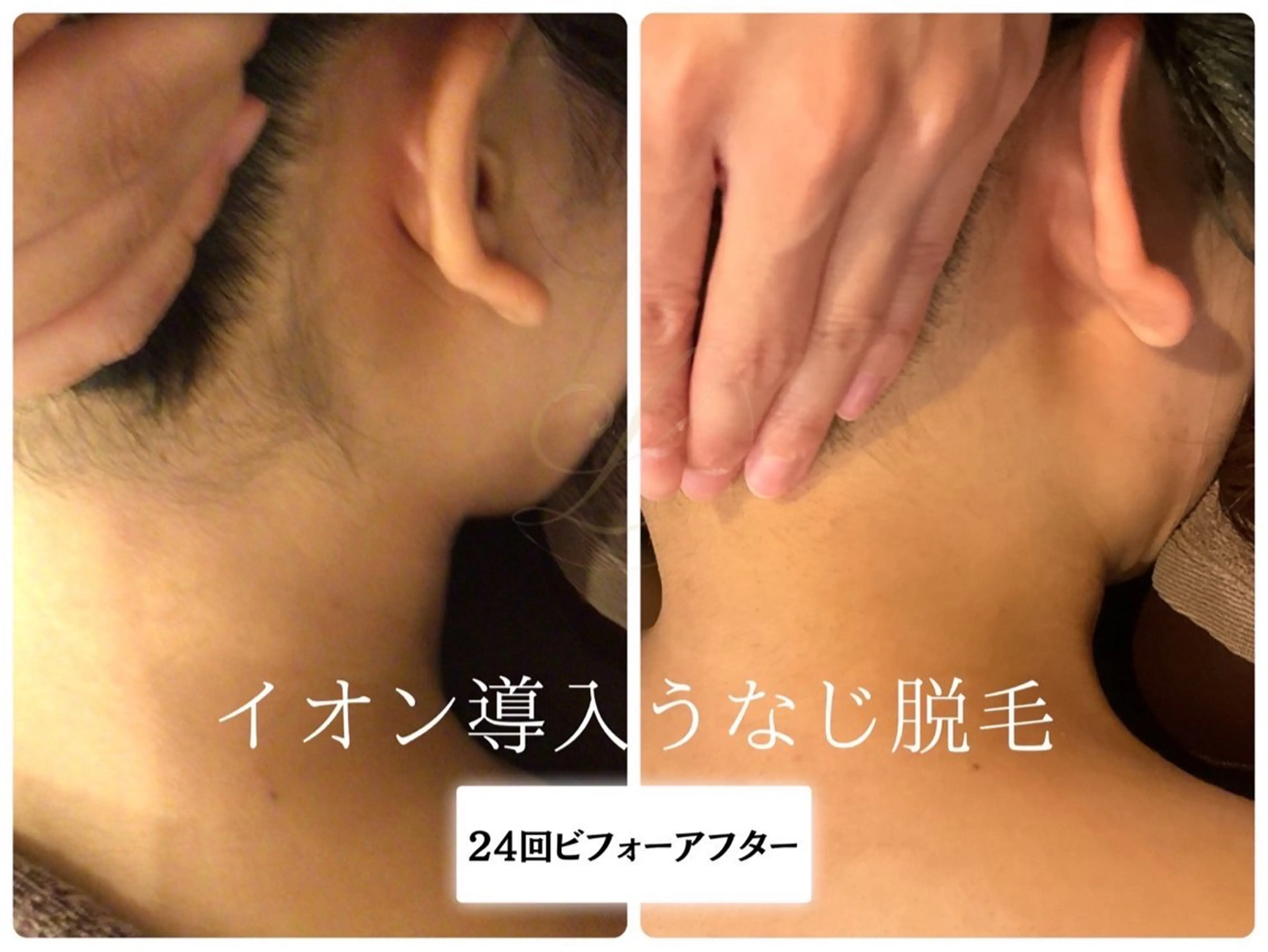 脱毛 Beauty  salon Lino所属・🎀うなじ脱毛🎀 ㅣLino堀江のエステ・リラクイメージ