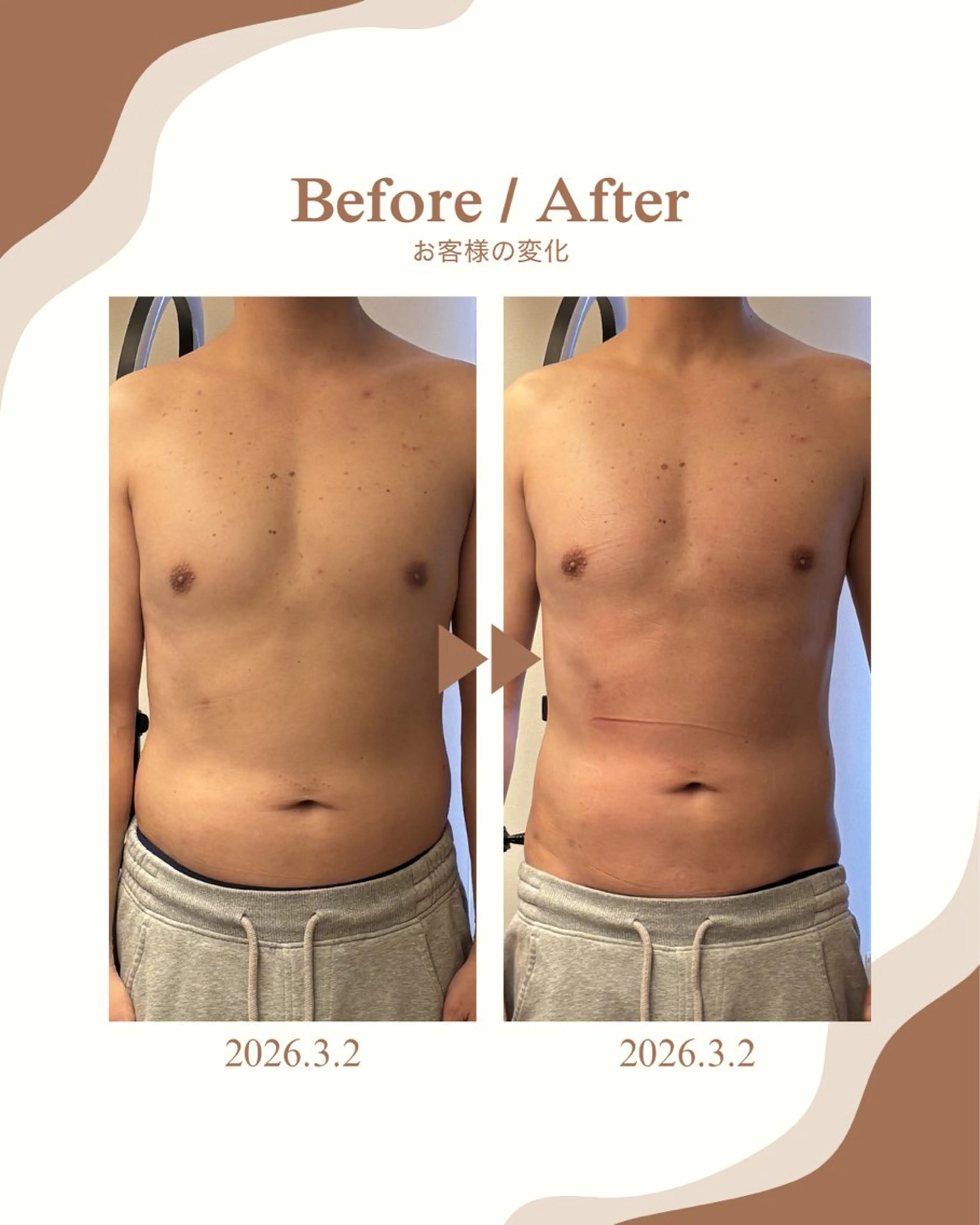 エステ 美肌脱毛／ニキビ ／肩こり／慢性疲労のエステ・リラクイメージ