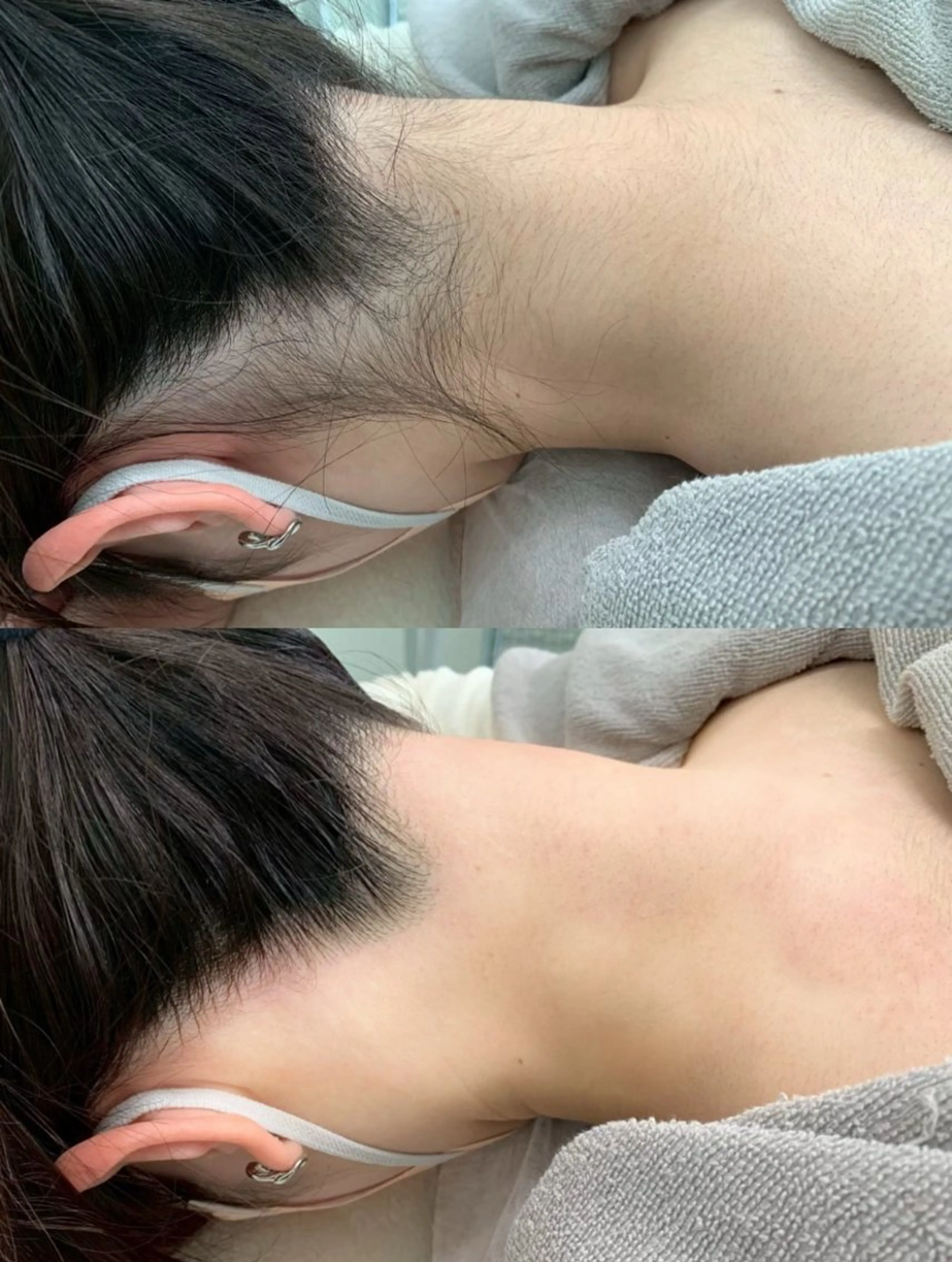 ☆夏前限定お得メニュー☆うなじ・背中上下脱毛の写真