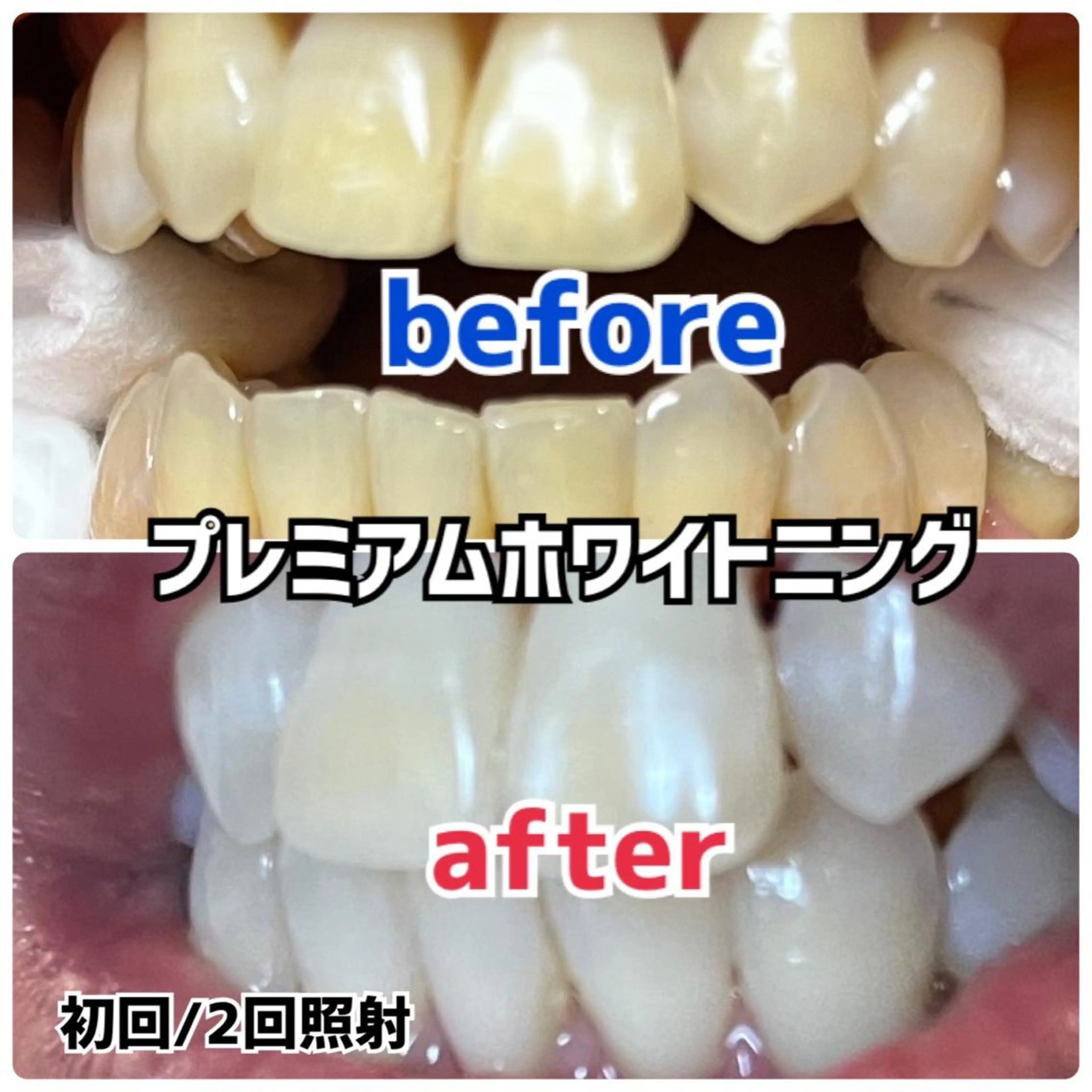 👩‍⚕️歯科医師監修！！ホワイトニング🦷染みにくく色戻りを最小限に❤️美ST雑誌掲載中💆‍♀️の写真