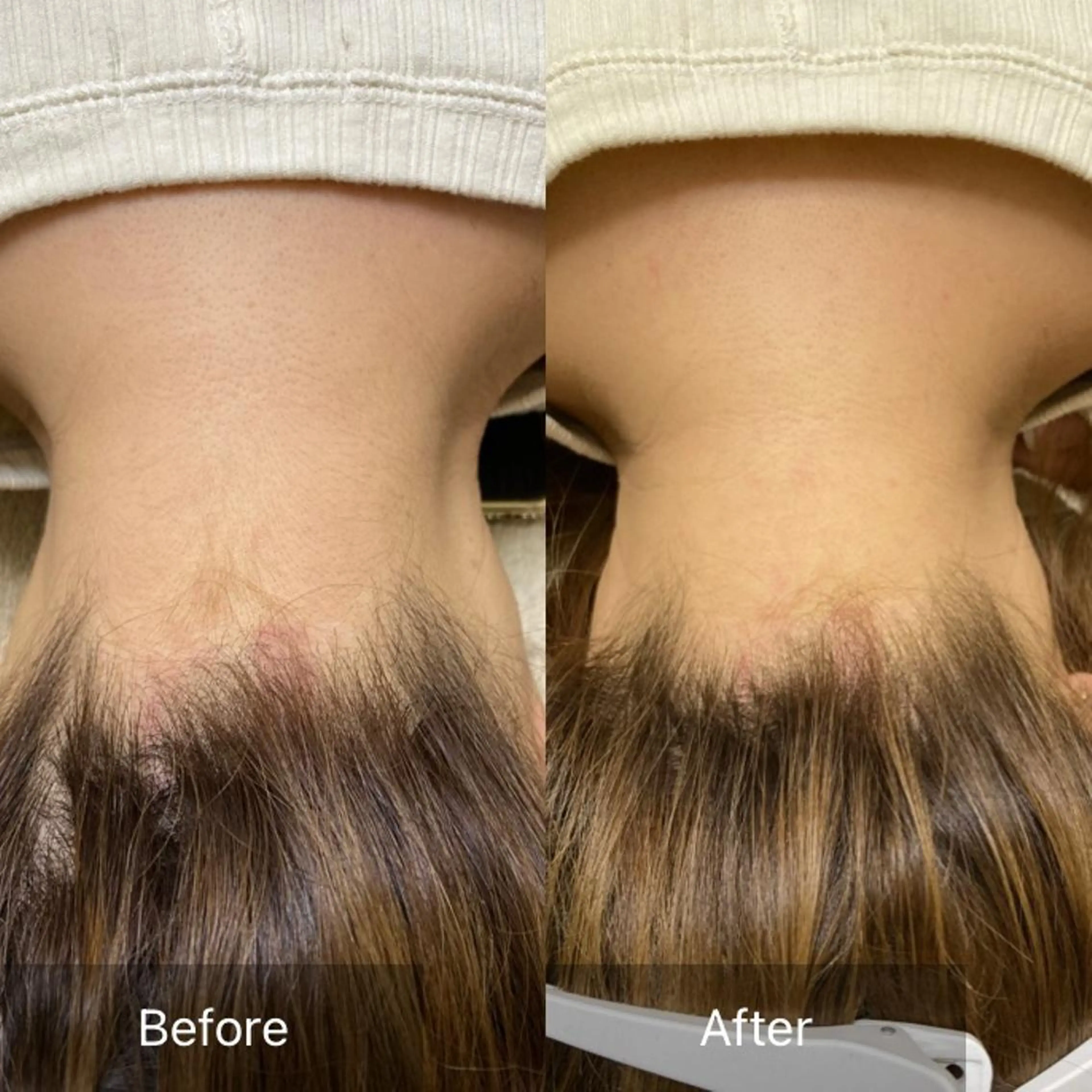 うなじWax脱毛の写真