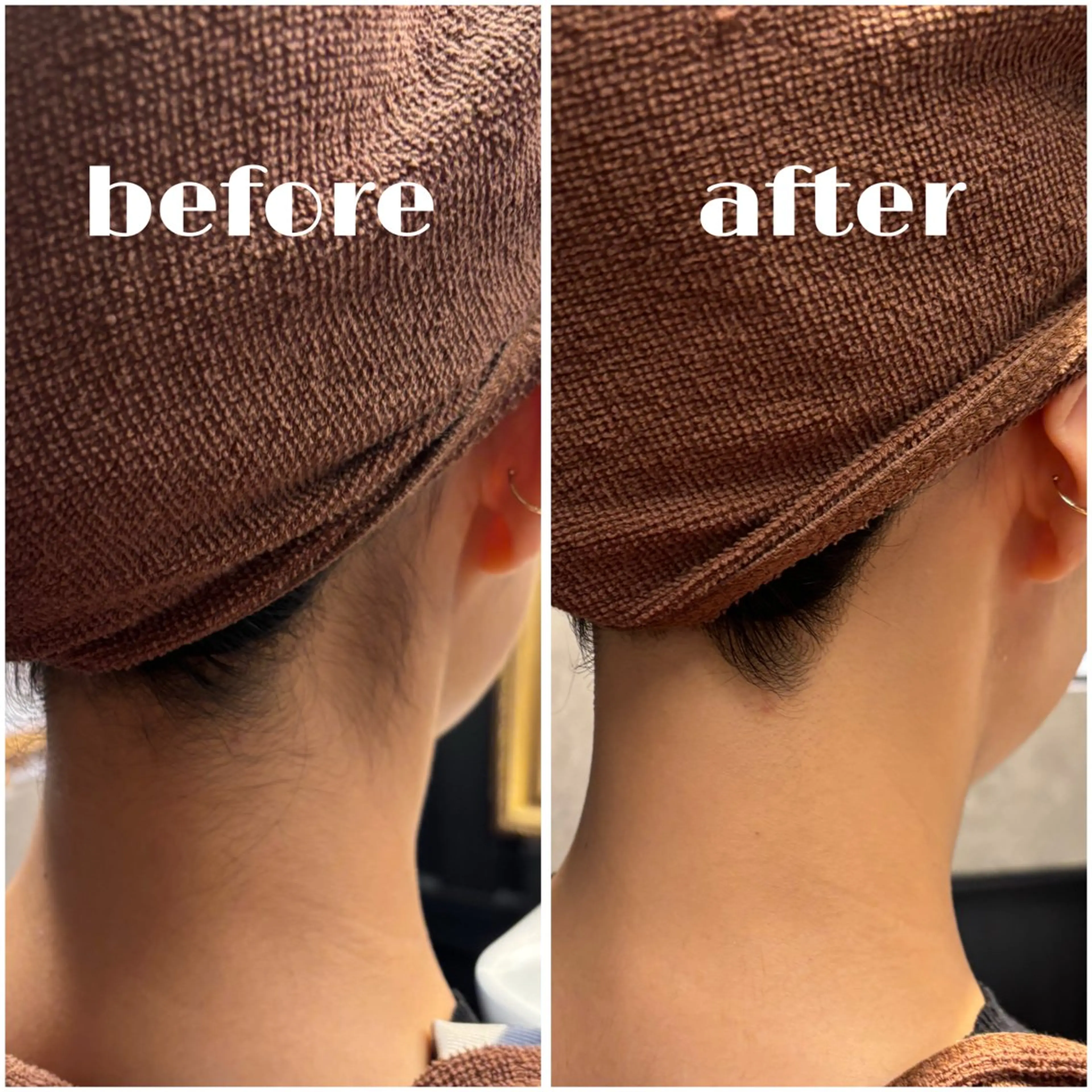 うなじシェービング+うなじ脱毛1回の写真