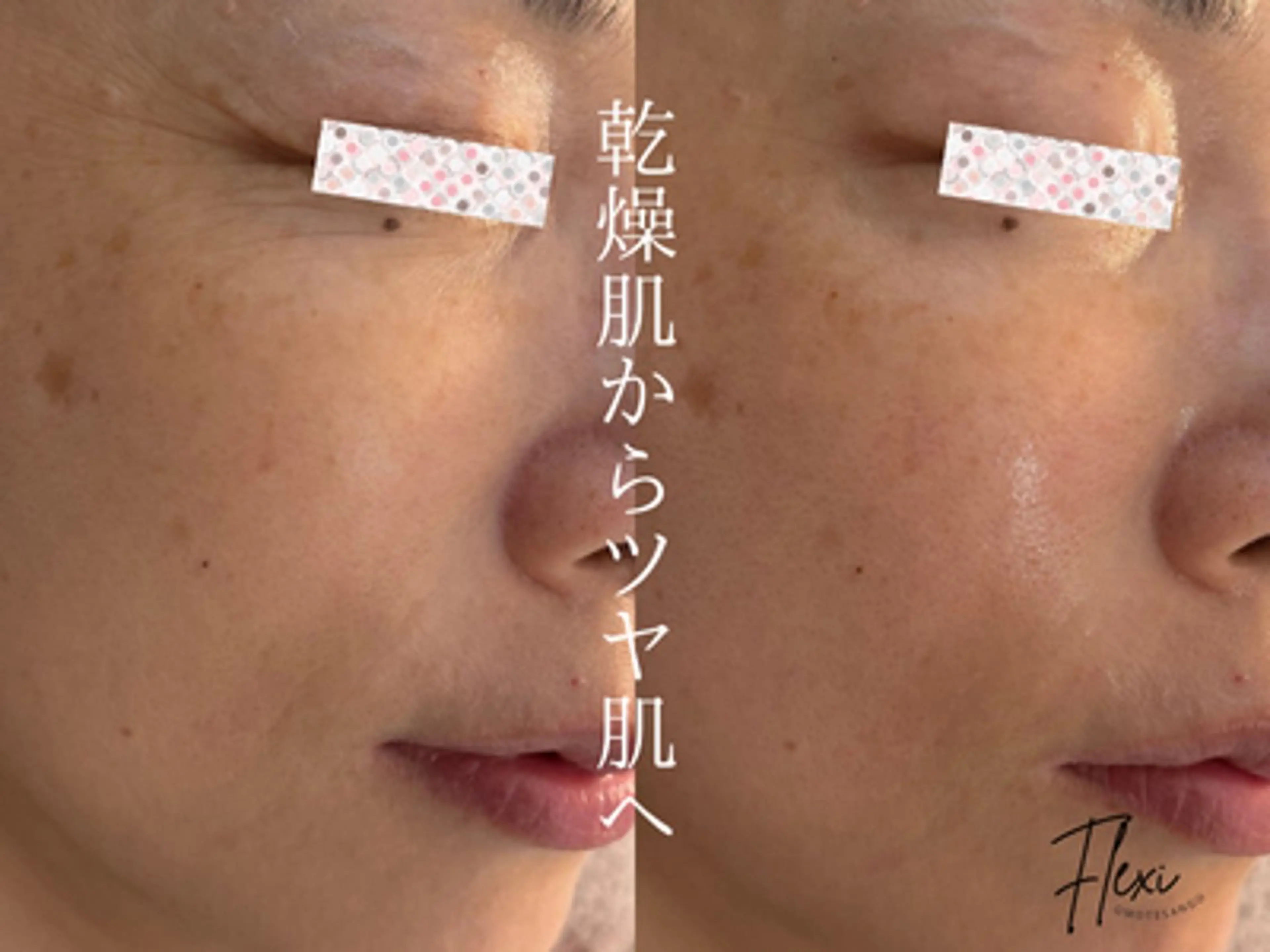 🌟ニキビ・毛穴ケア 🌿Flexi表参道のエステ・リラクイメージ