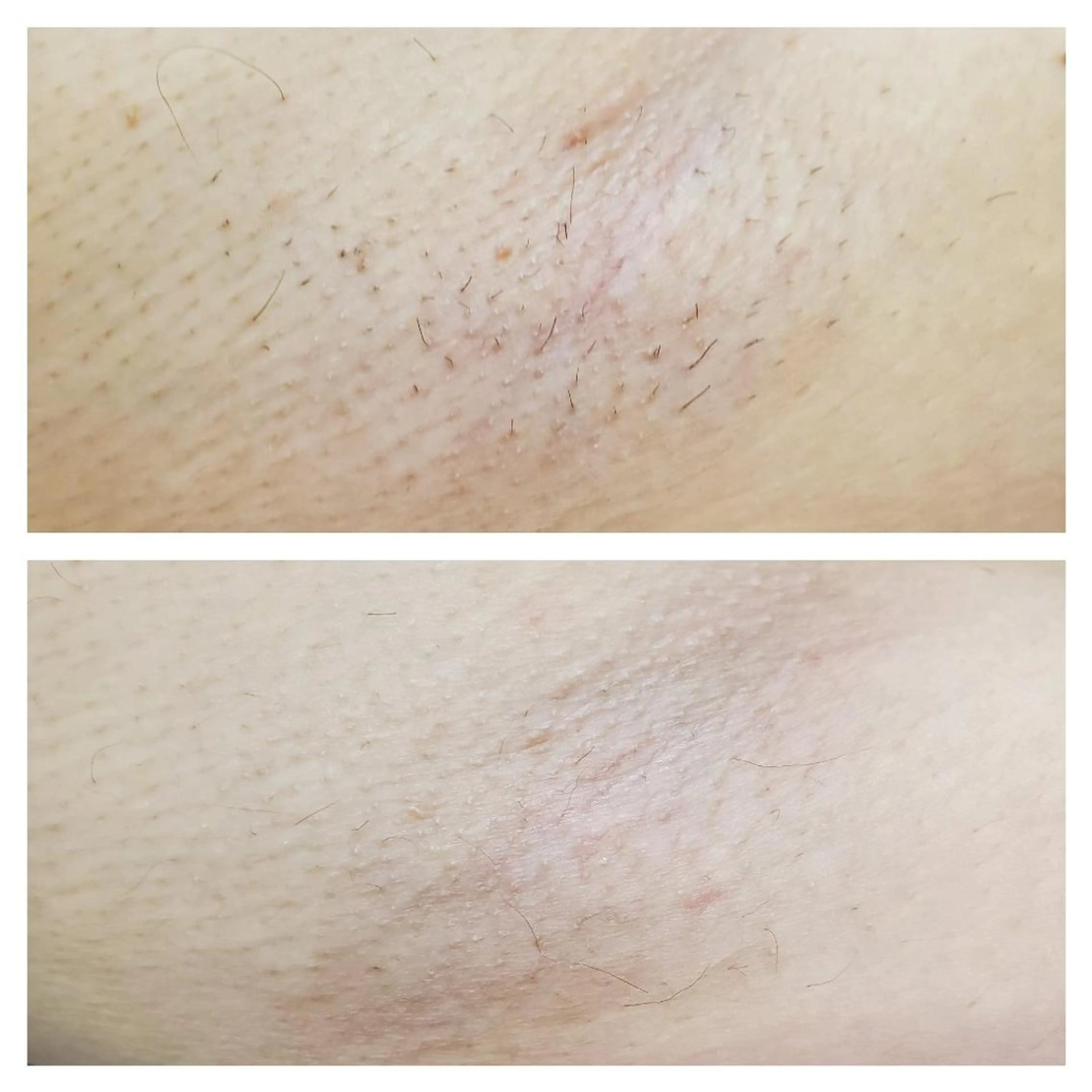 【中学生&高校生だけ!★10分脱毛★両脇】の写真