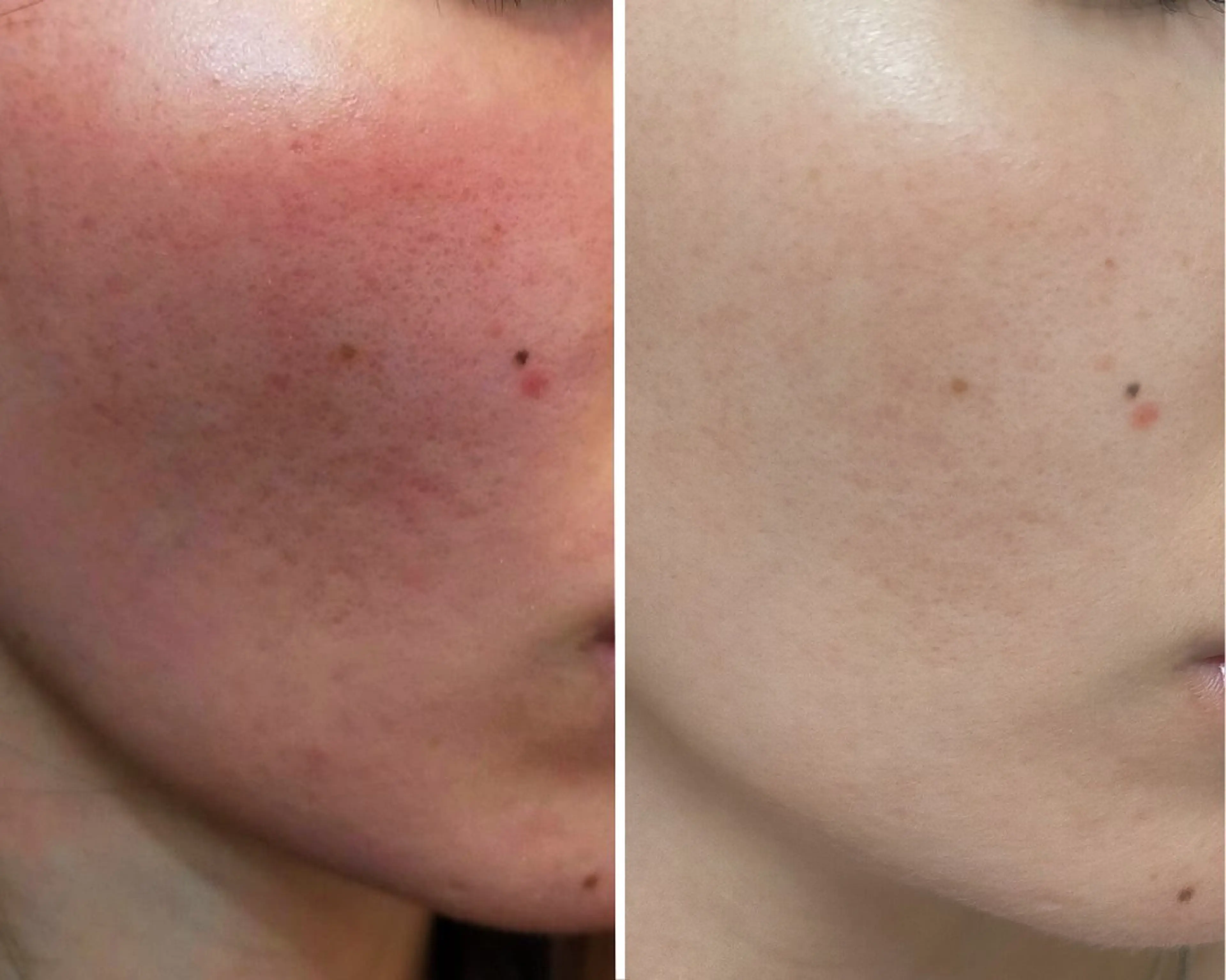 エステ 本気の肌質改善/ ハーブピーリングのエステ・リラクイメージ