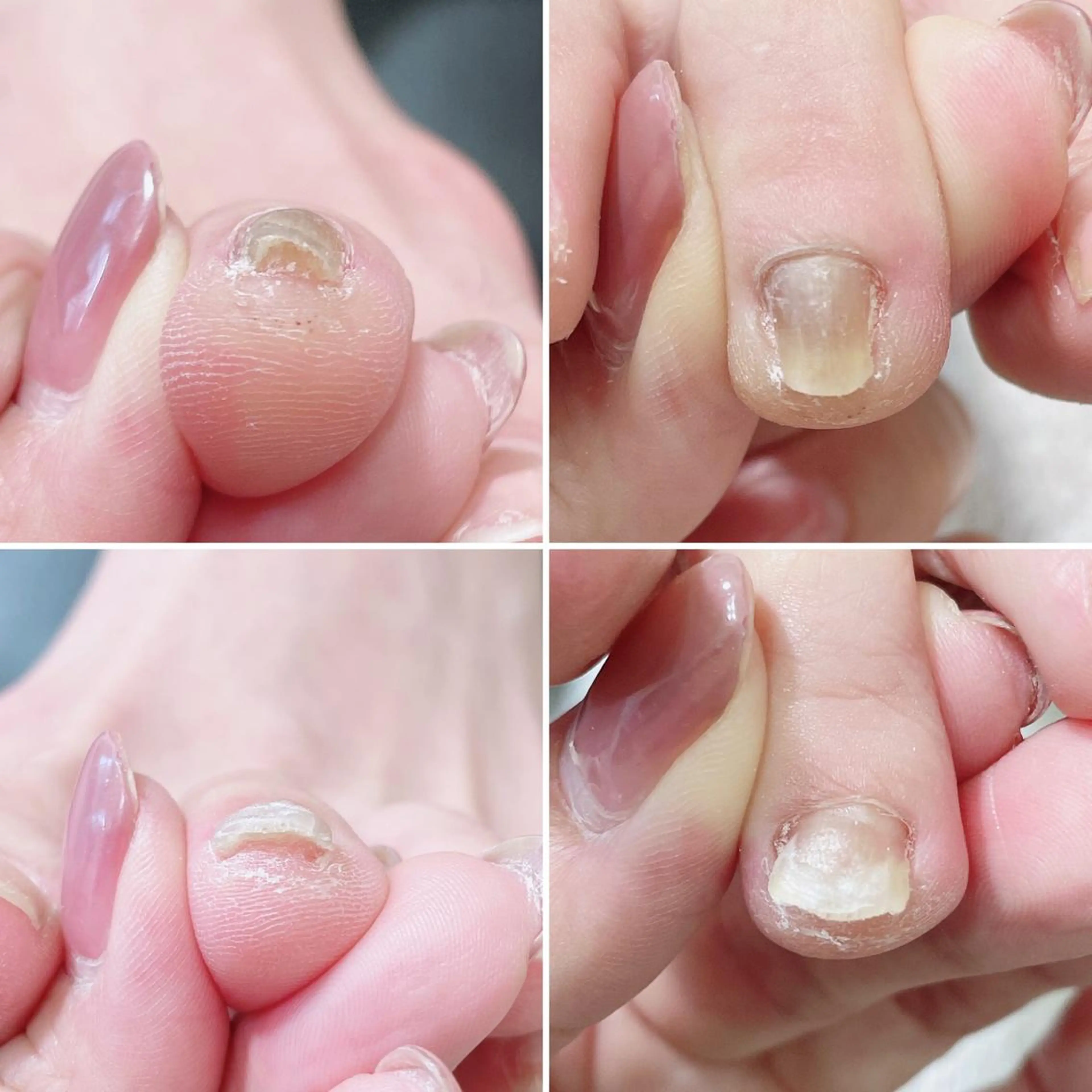 ネイル 深爪・巻き爪 専門サンセリテのネイルデザイン