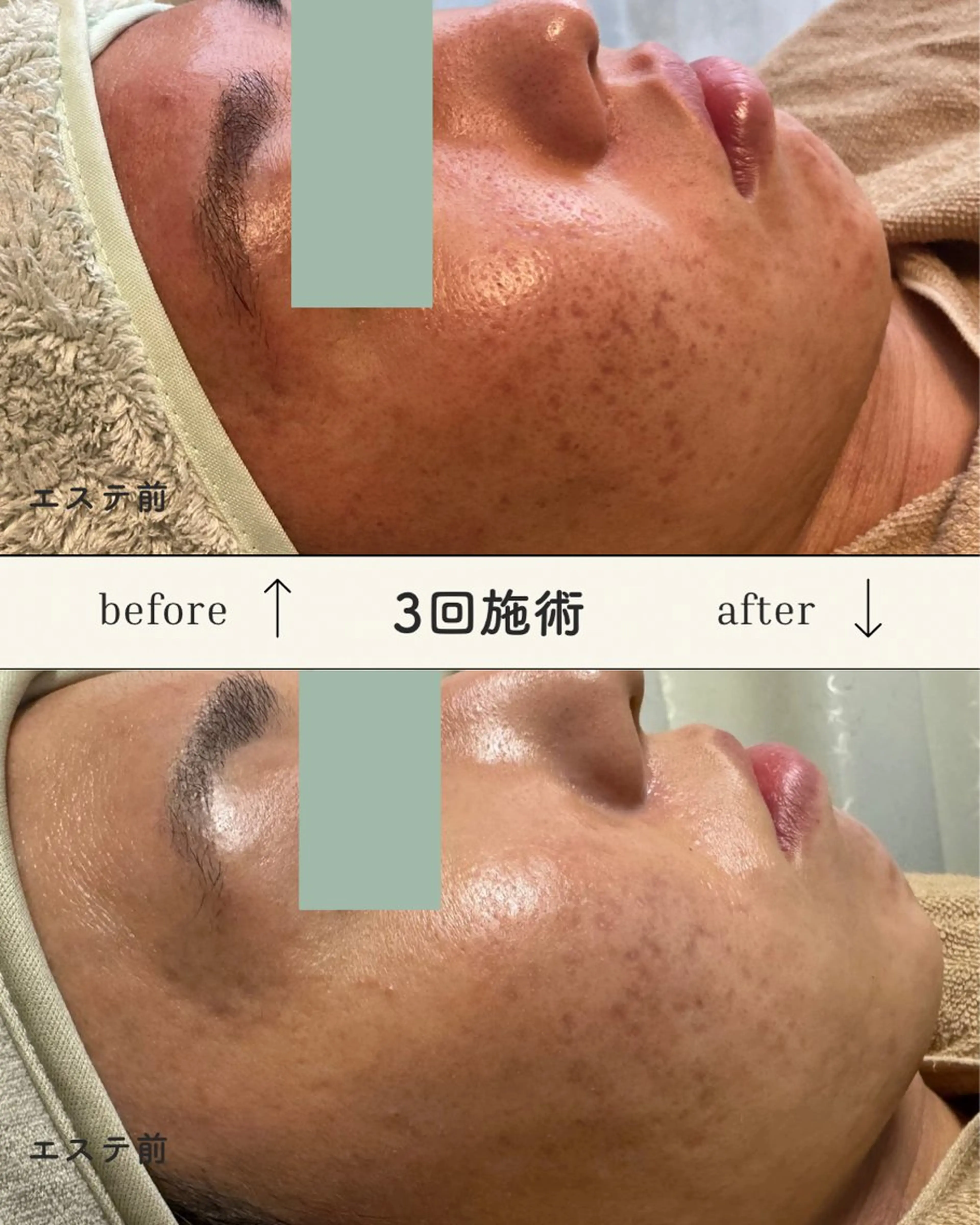 【モニター】ニキビ、ニキビ跡専用エステの写真