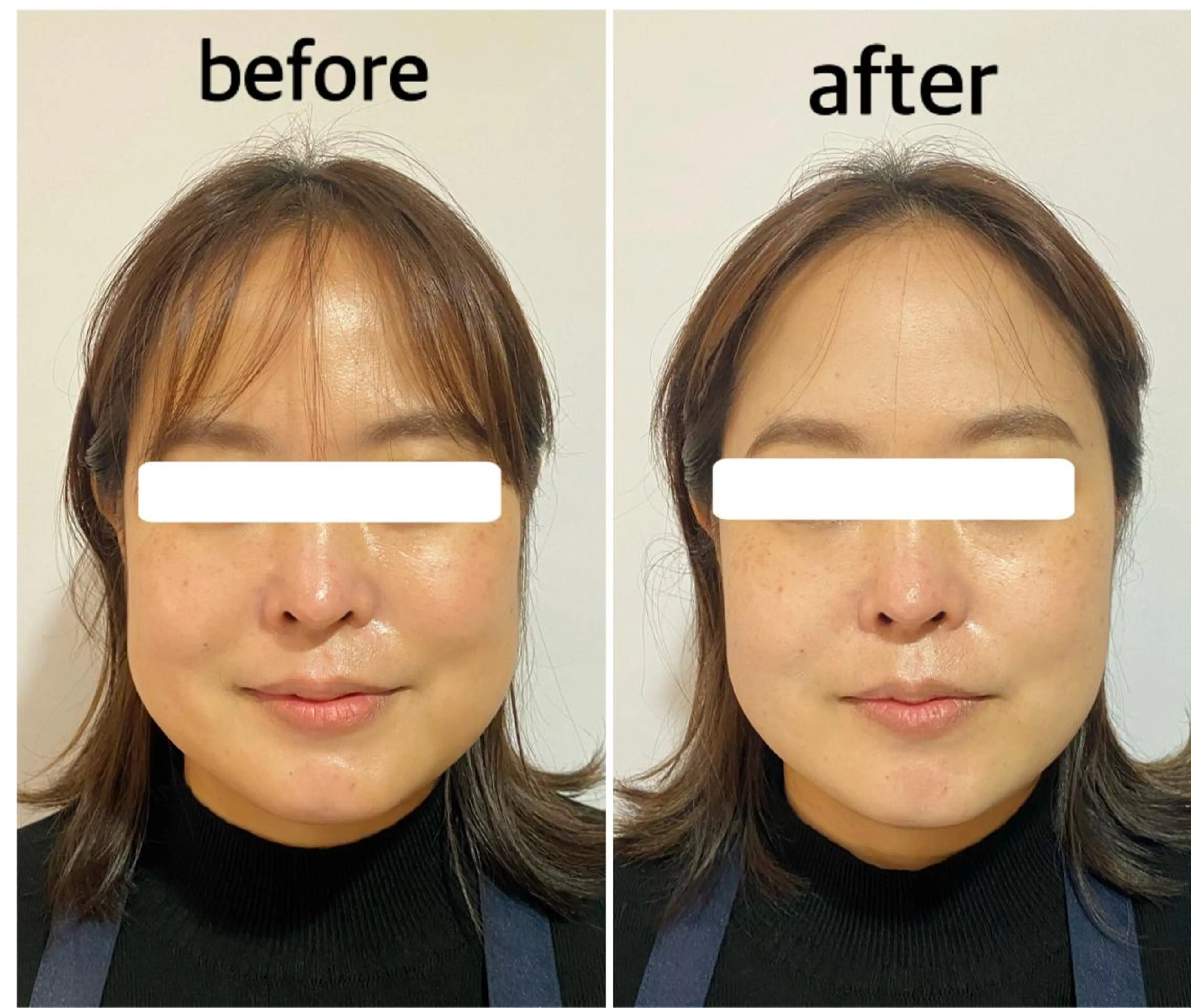 痛くない小顔矯正の写真