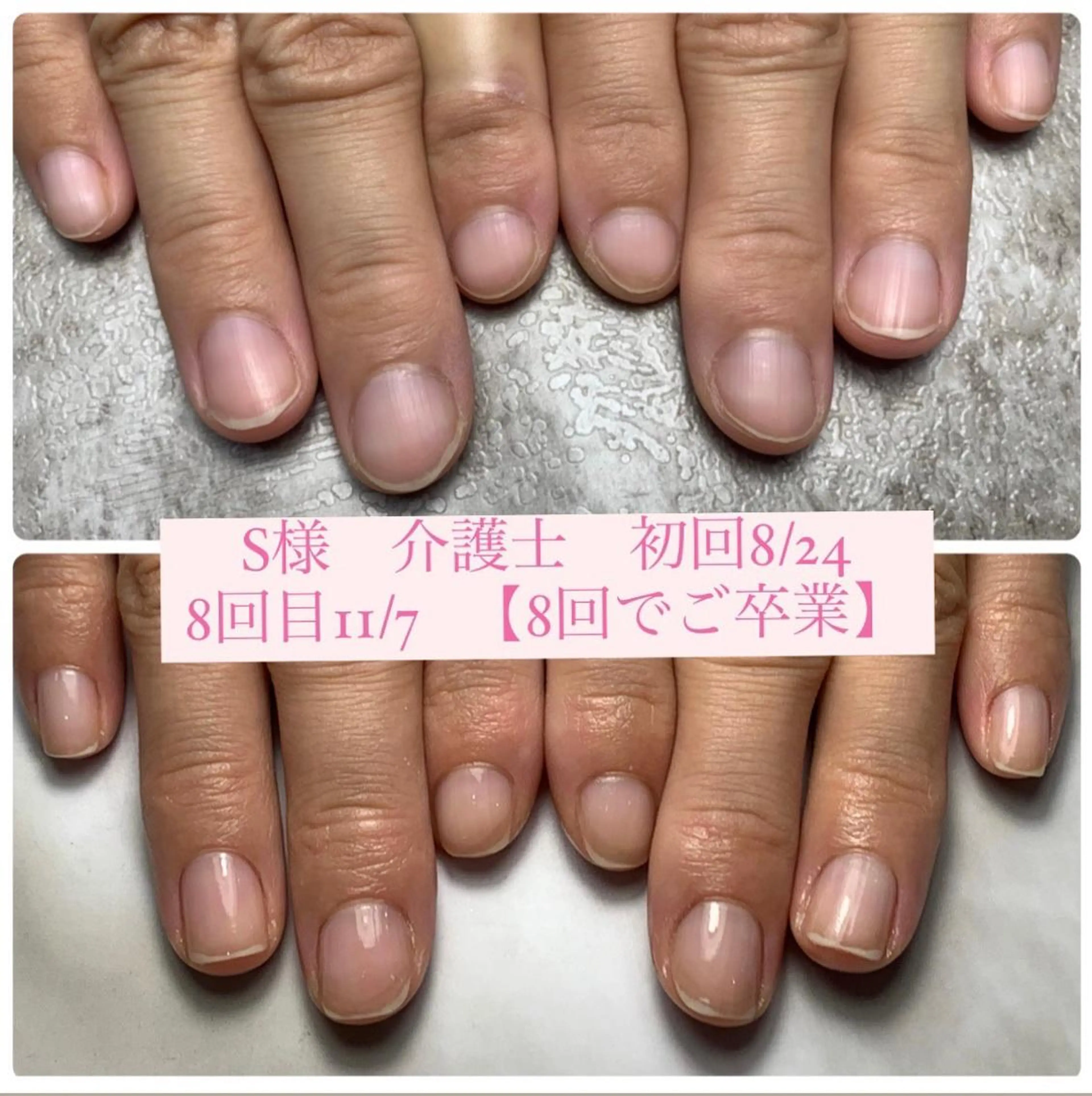 ネイル 自爪育成/深爪矯正 mikiのネイルデザイン