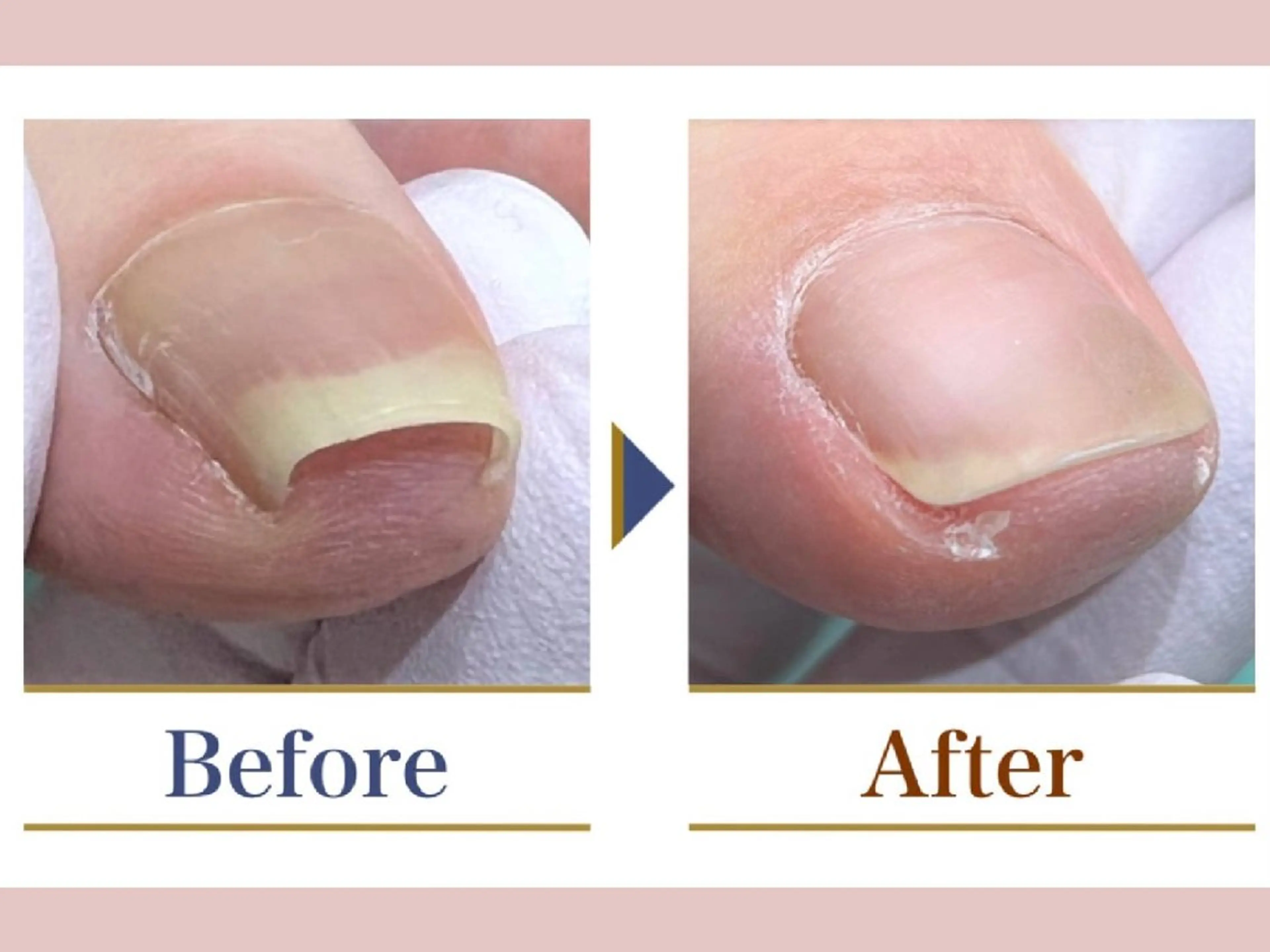 【巻き爪1箇所】痛みがある方!痛みがなくても巻きが強い方!!専用の器具で優しく、効果的な施術をいたします。の写真