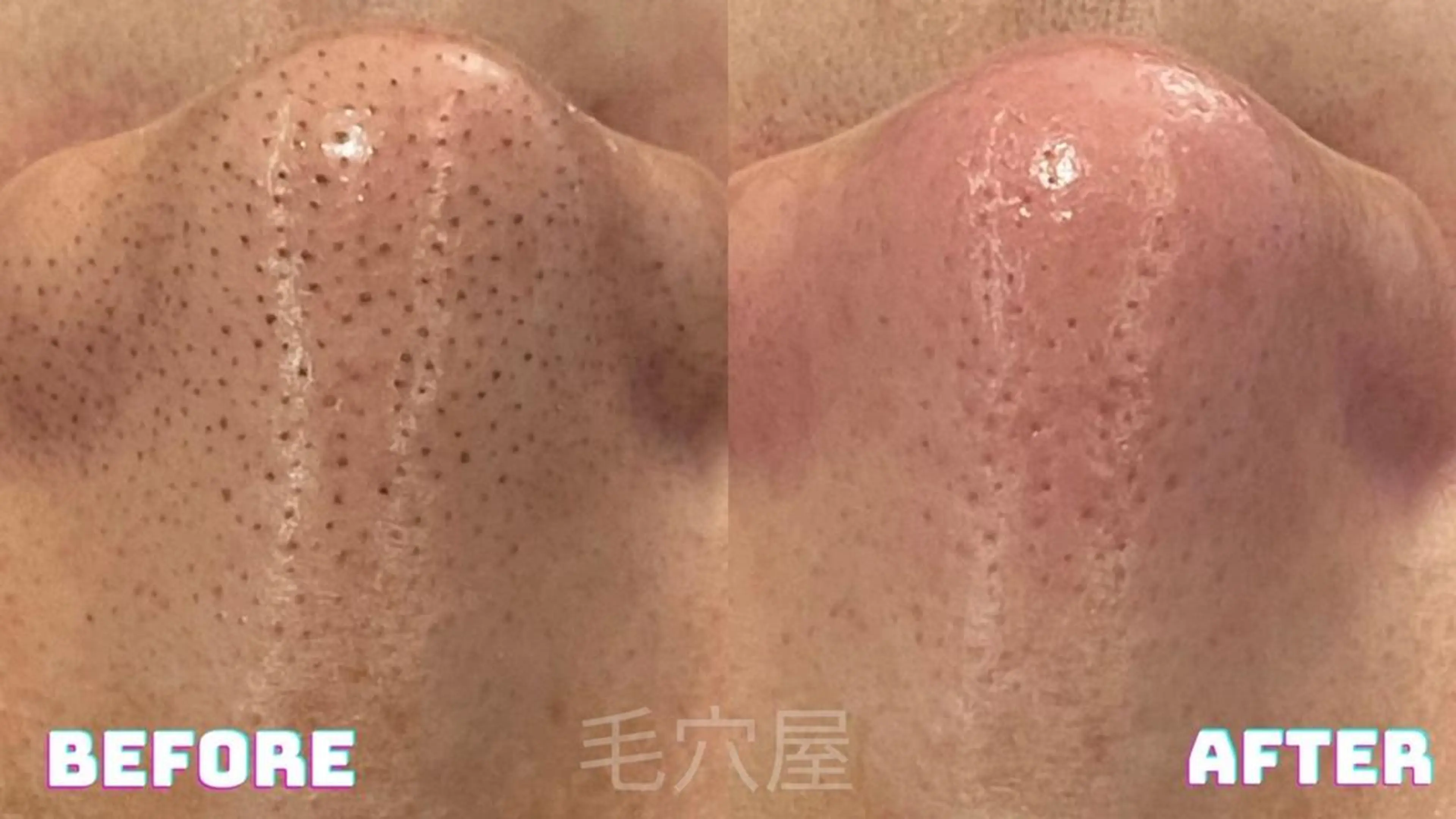 鼻エクストラクション+ハイドラ+美容液導入+毛穴引き締めパック付¥6900の写真