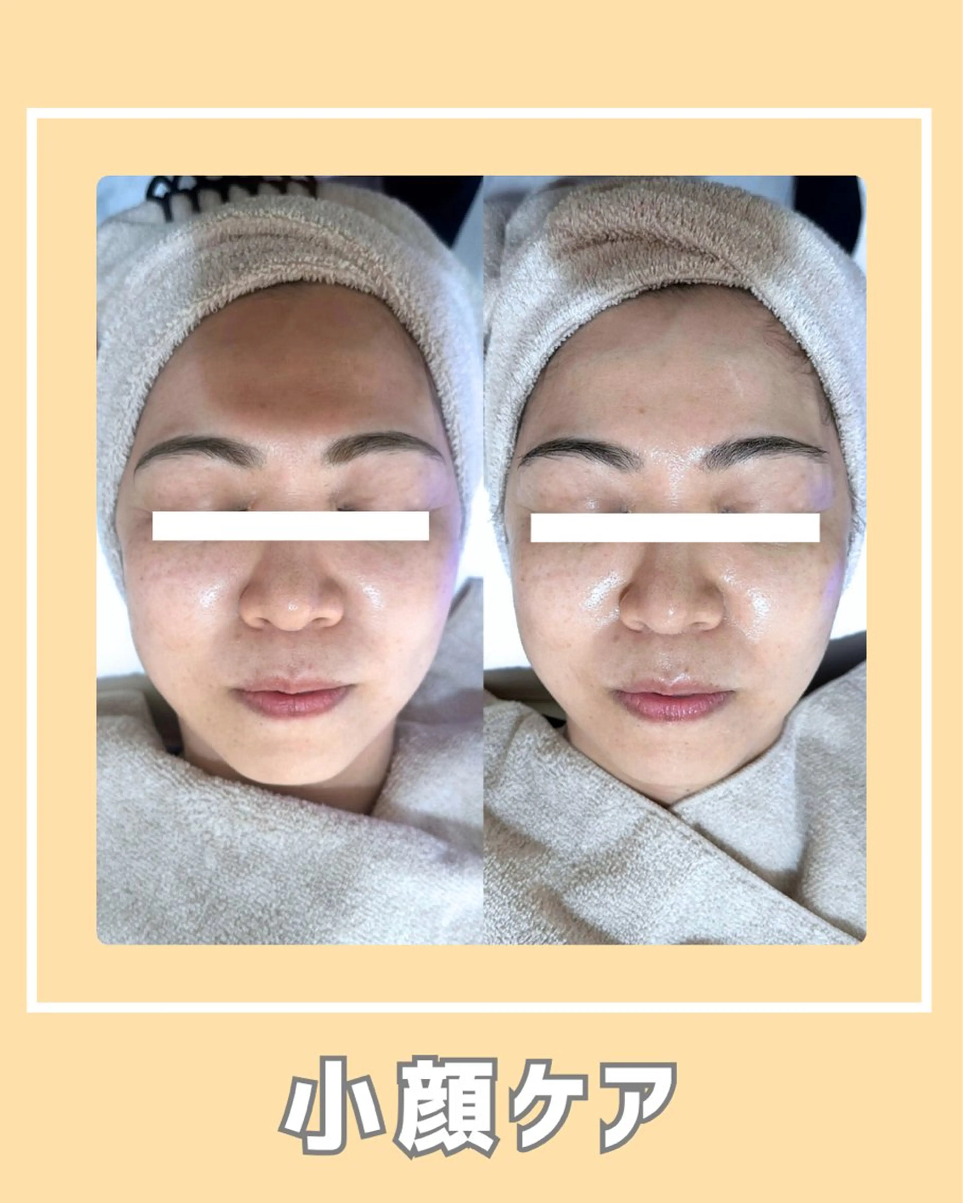 その他 |ピーリング・毛穴| soina神楽坂のエステ・リラクイメージ