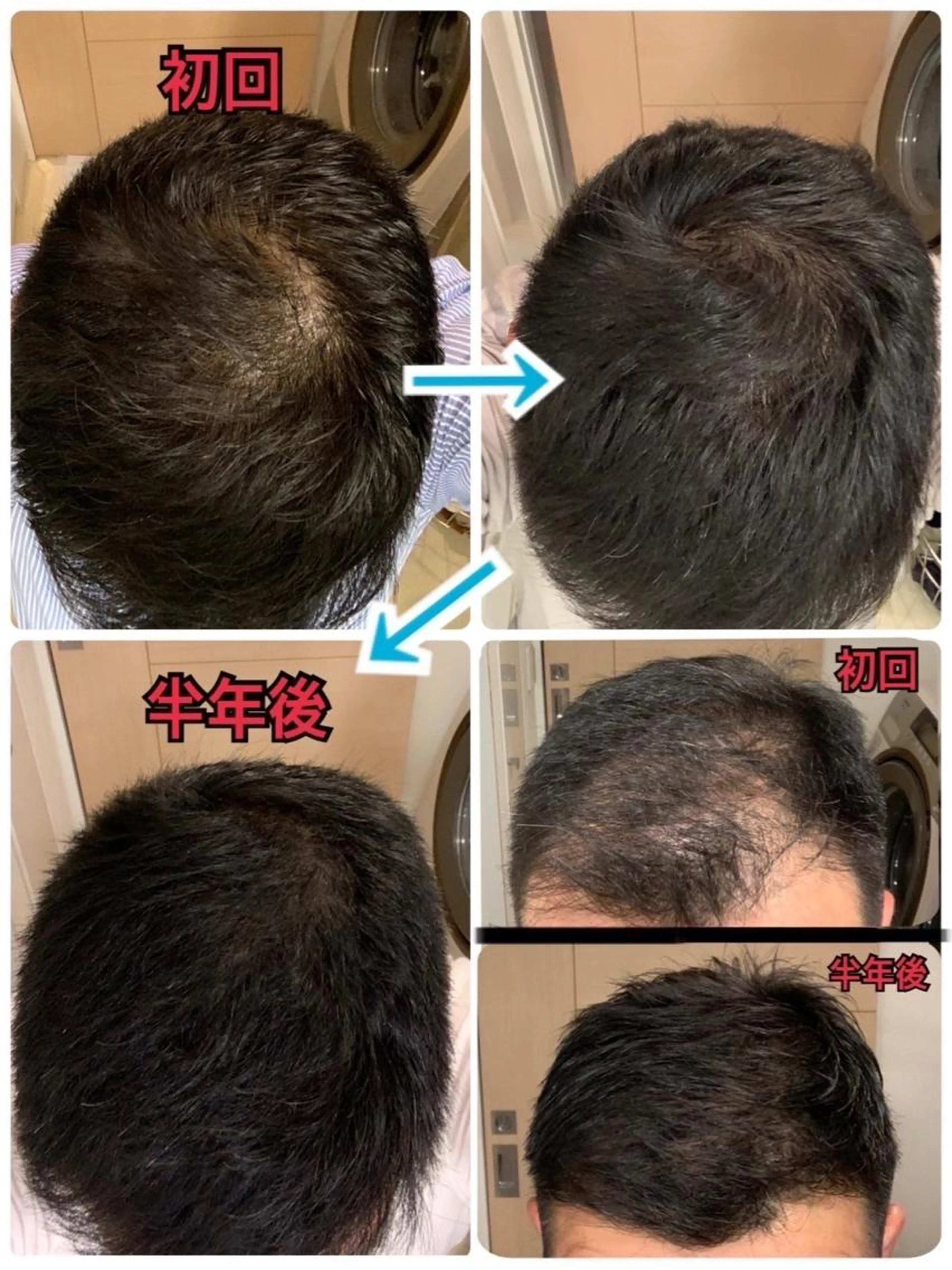 《初回限定》LEDスカルプケア　赤色LEDと高機能スカルプエッセンスによる頭皮エステの写真