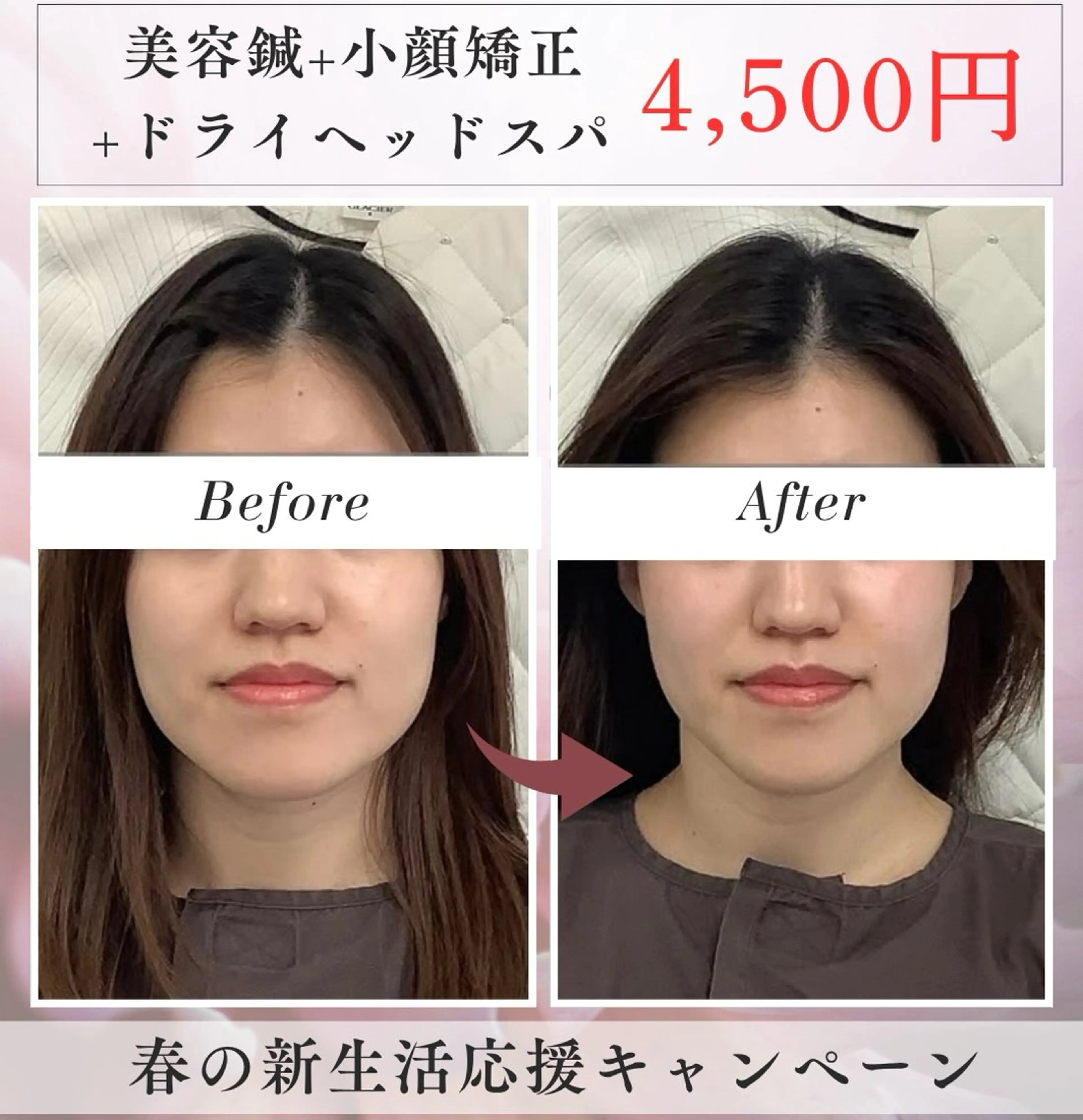 【👑人気No.1👑】美容鍼+小顔矯正+ドライヘッドスパ(60分)の写真