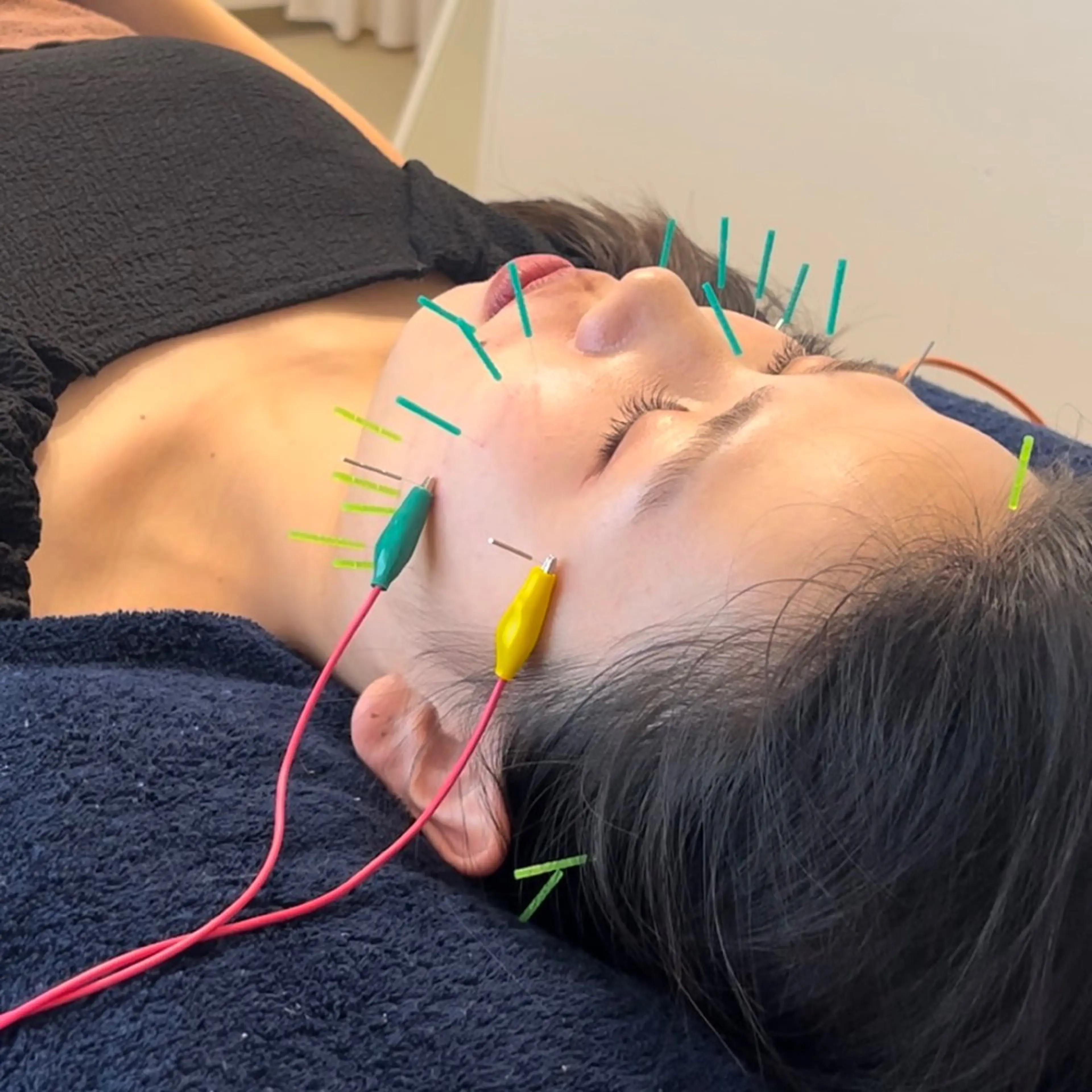 美容鍼×小顔×猫背× ブライダル 大阪梅田のエステ・リラクイメージ