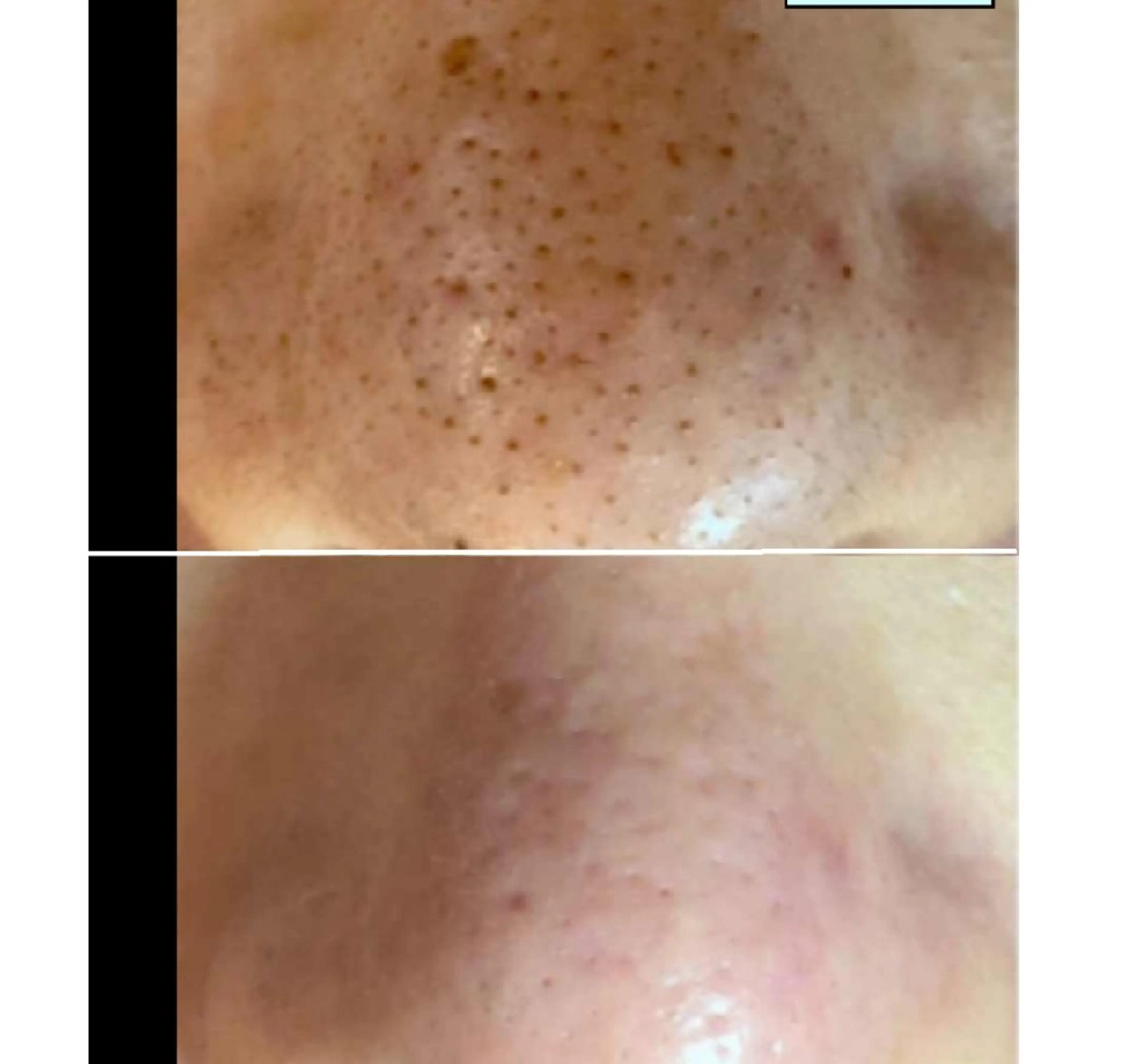 【初回】メンズ専門『イチゴ鼻撃退』韓国式毛穴洗浄(お試し鼻プラン)の写真