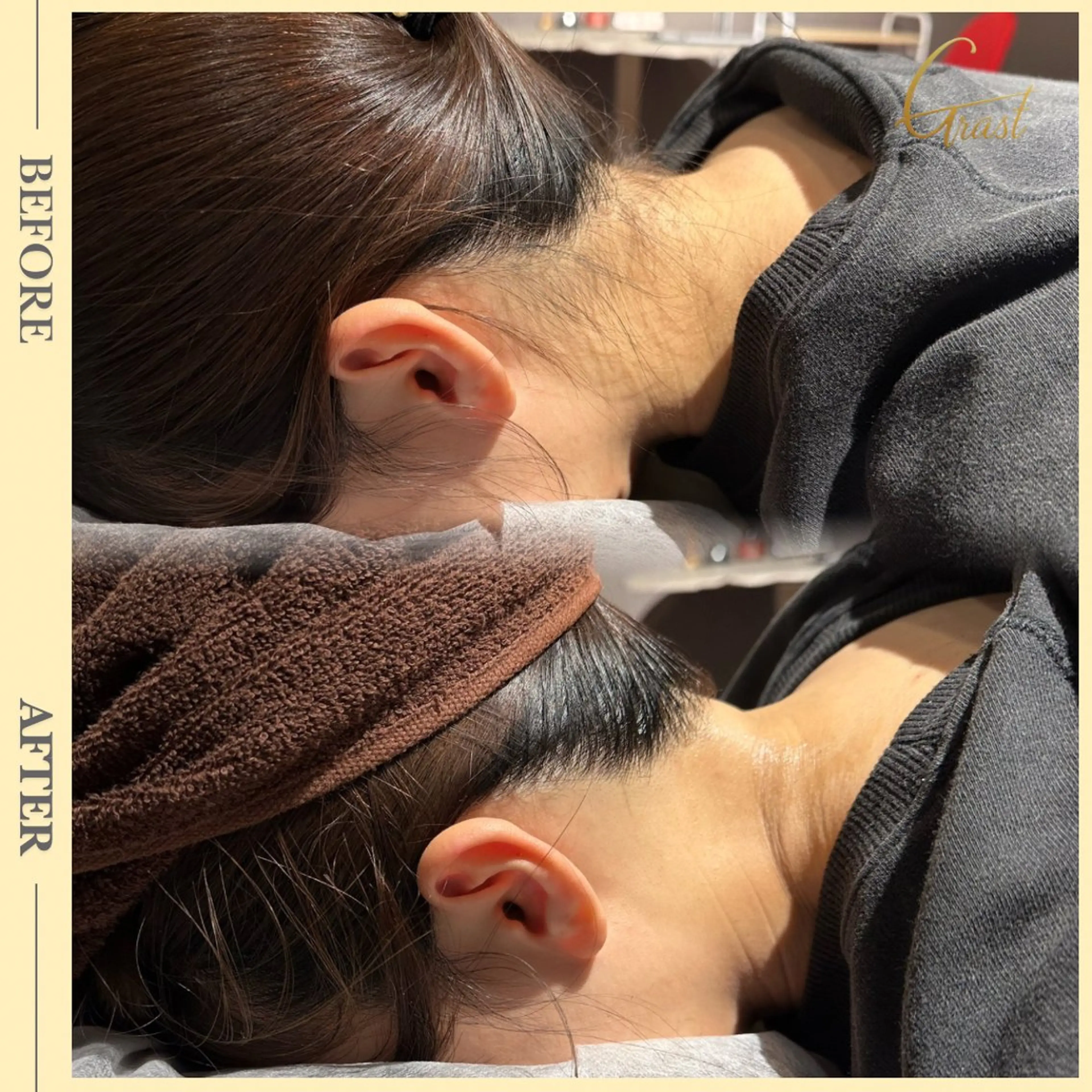 人気No.1★【うなじ脱毛】うなじワックス+光脱毛 『髪が綺麗にまとまる首元スッキリデザイン』の写真