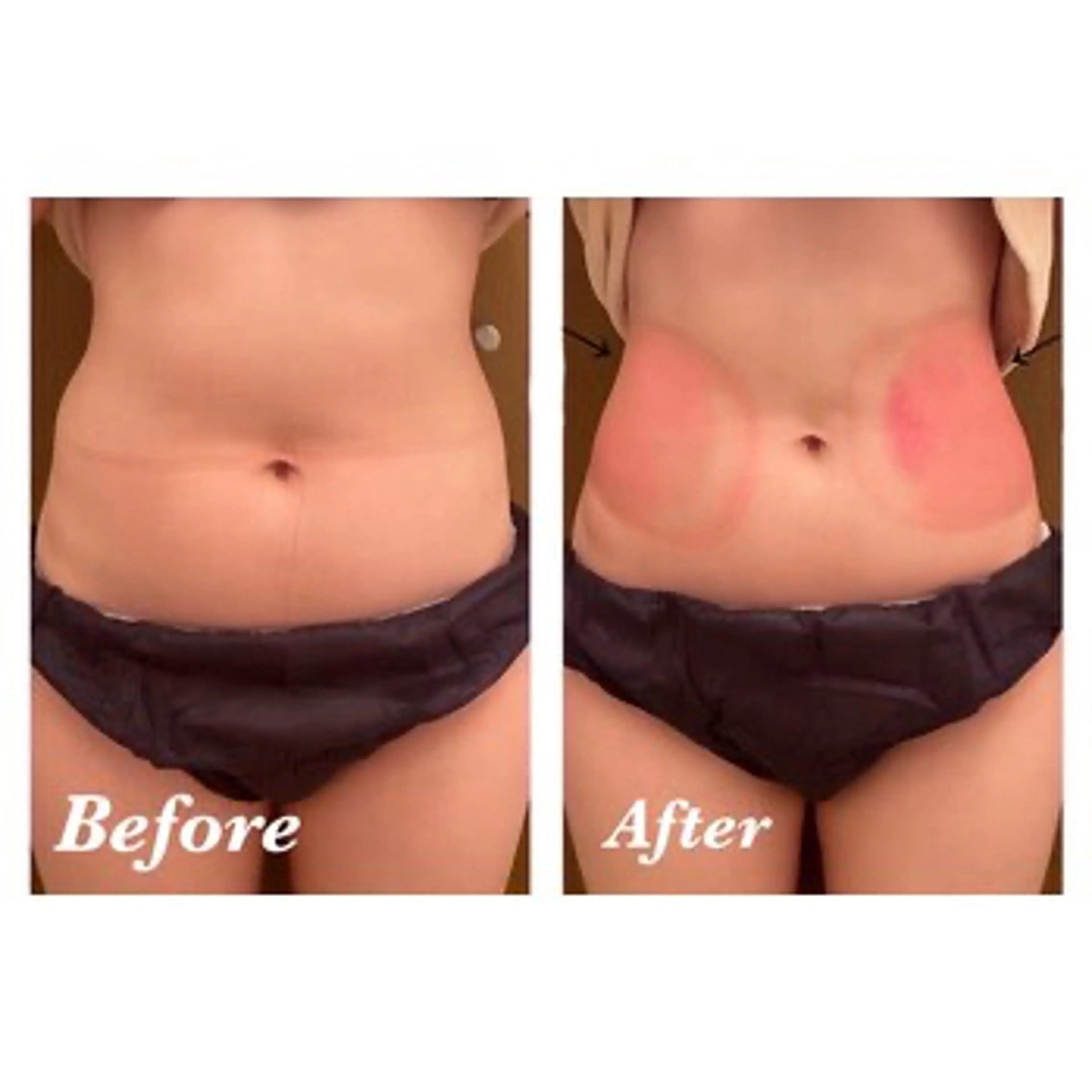 【1箇所】❄️-12℃冷却痩身❄️の写真