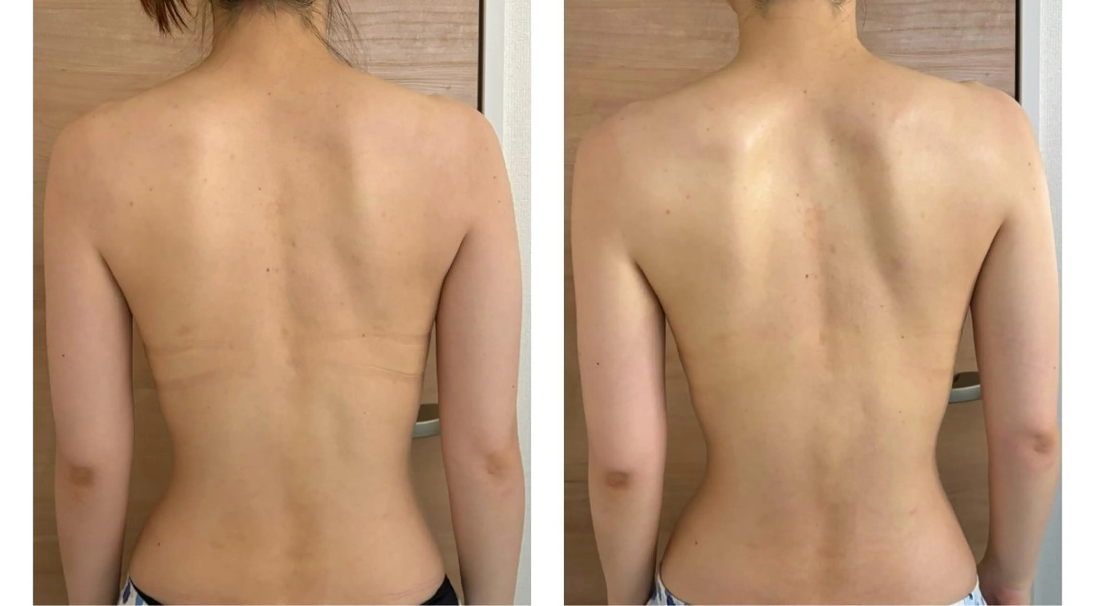 巻き肩改善！背中二の腕美人✨ブライダルで必須！天使の羽コース👼60分の写真