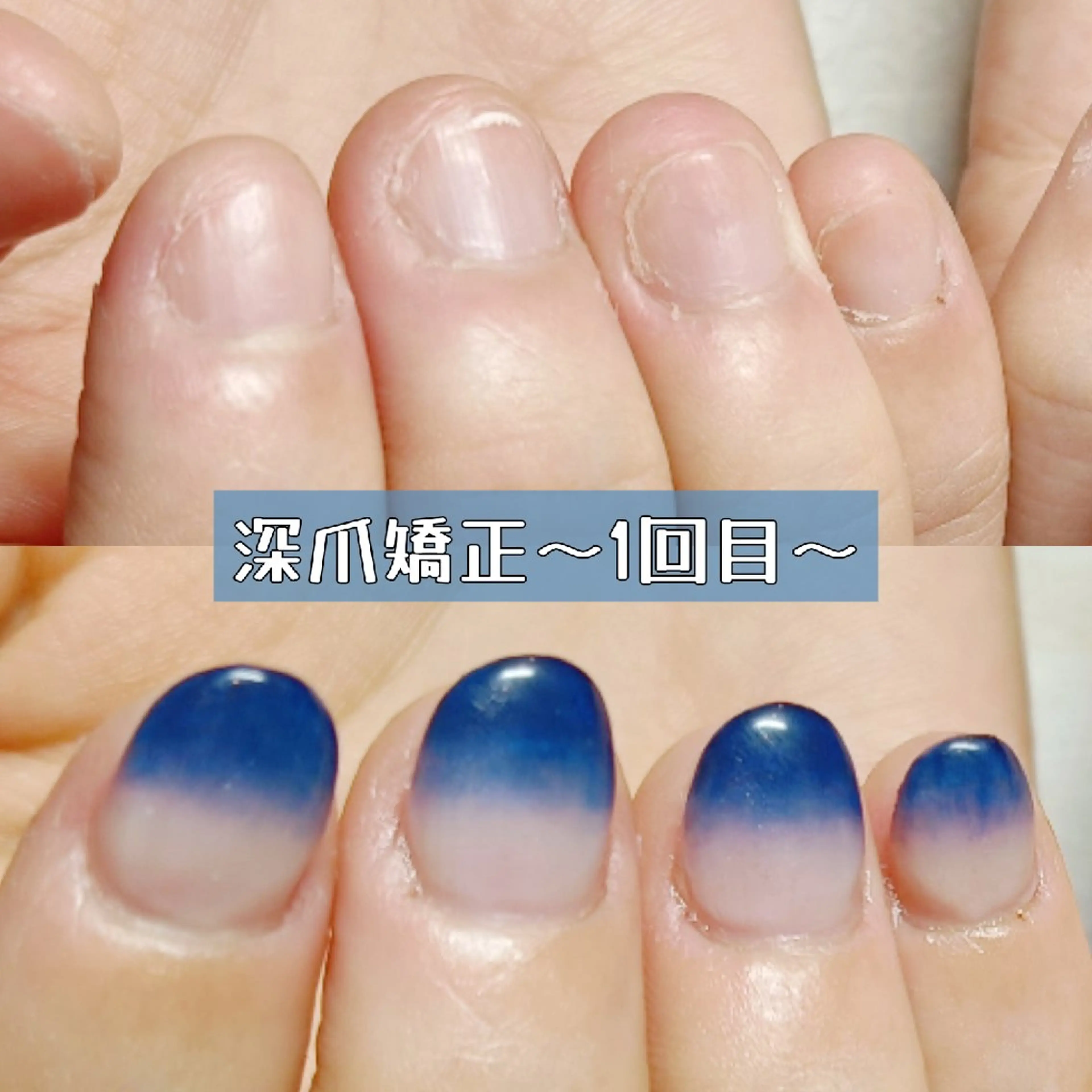 ネイル ハンドネイル ハンドケア 深爪矯正/爪育成ケア manie nailのネイルデザイン