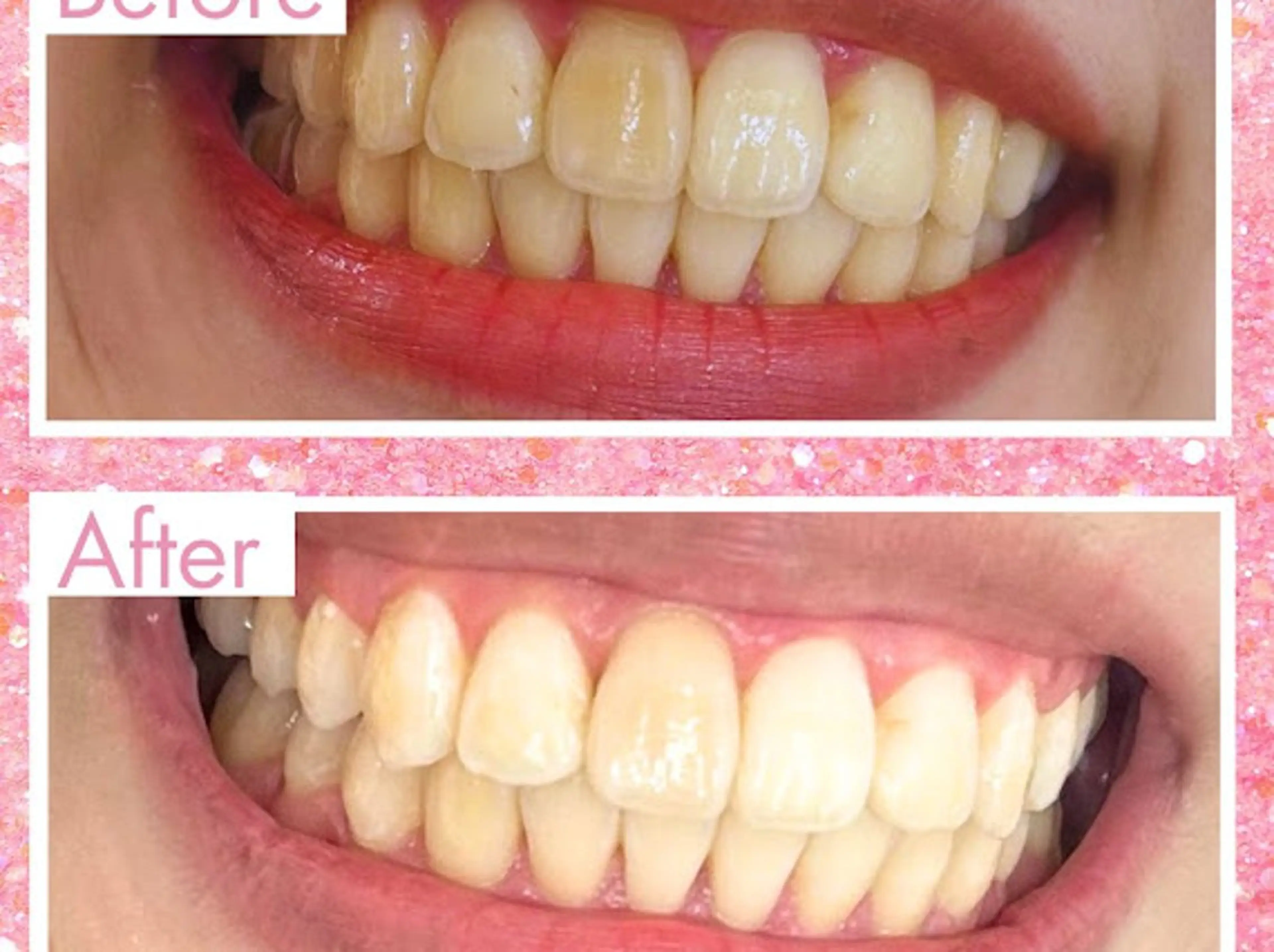 【minimo掲載記念🎉】セルフホワイトニング《9分×2回》¥390別途料金なし！の写真