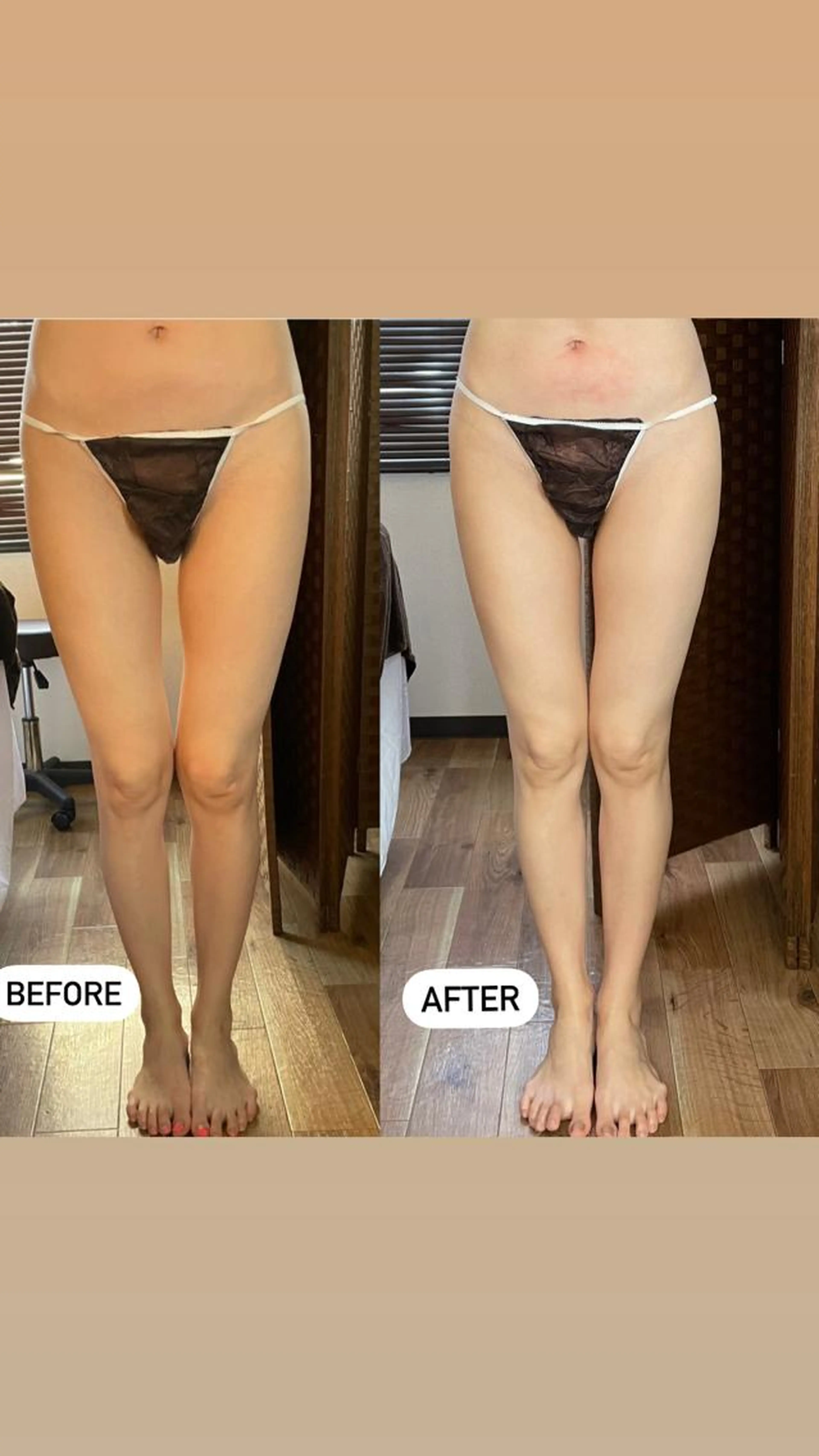 O脚改善美脚コースの写真