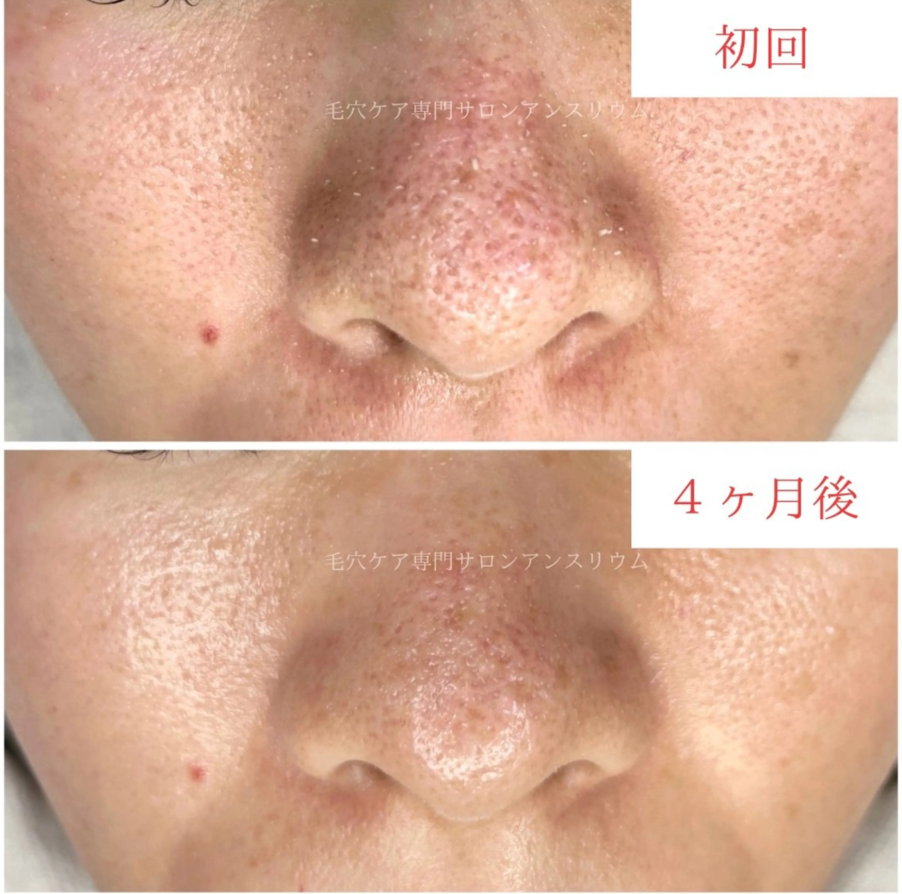 毛穴ケア専門サロンアンスリウム所属・茨城土浦 つくば毛穴 ケア専門サロンのエステ・リラクイメージ